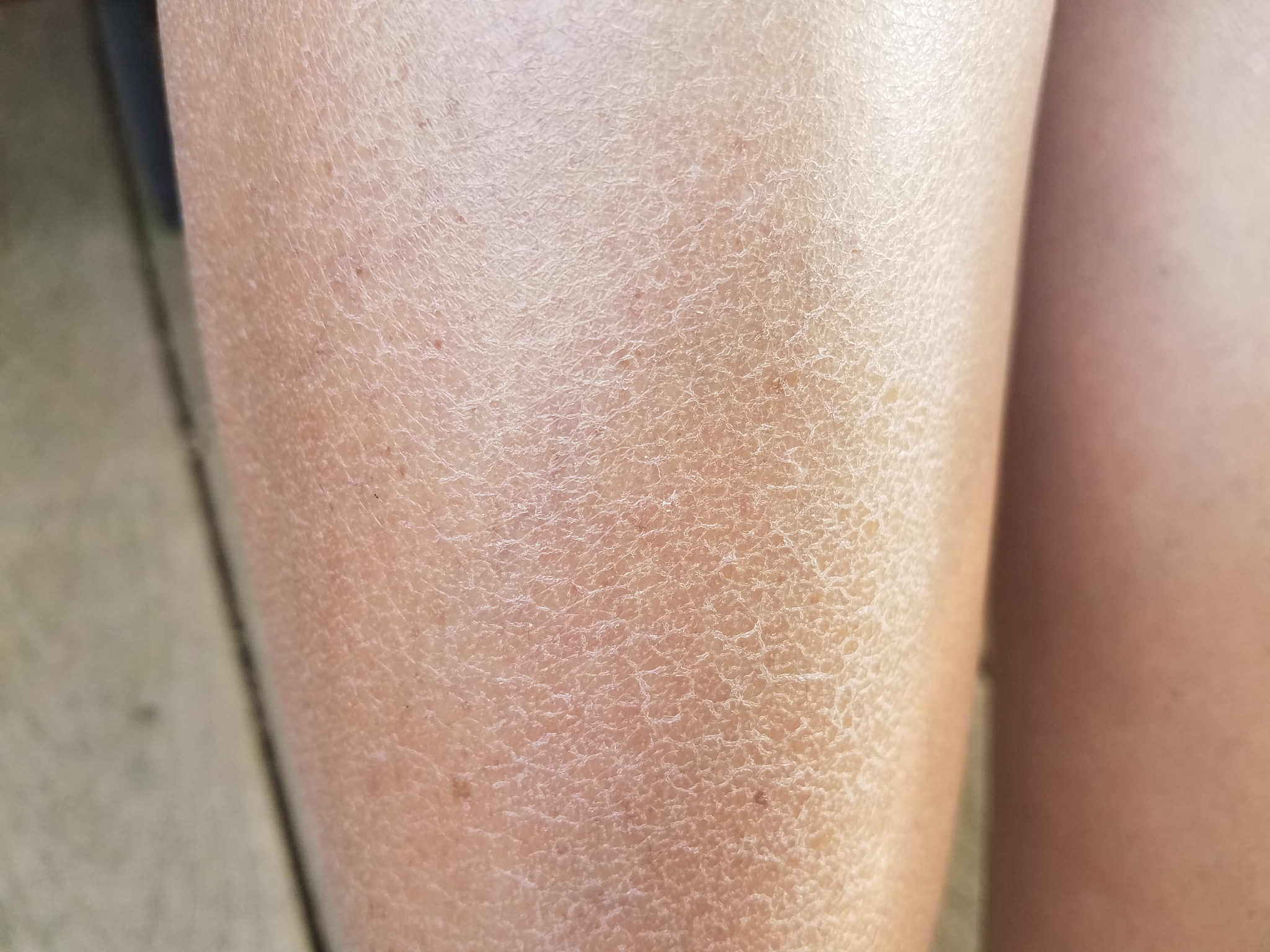 腿上毛孔大粗糙怎么办