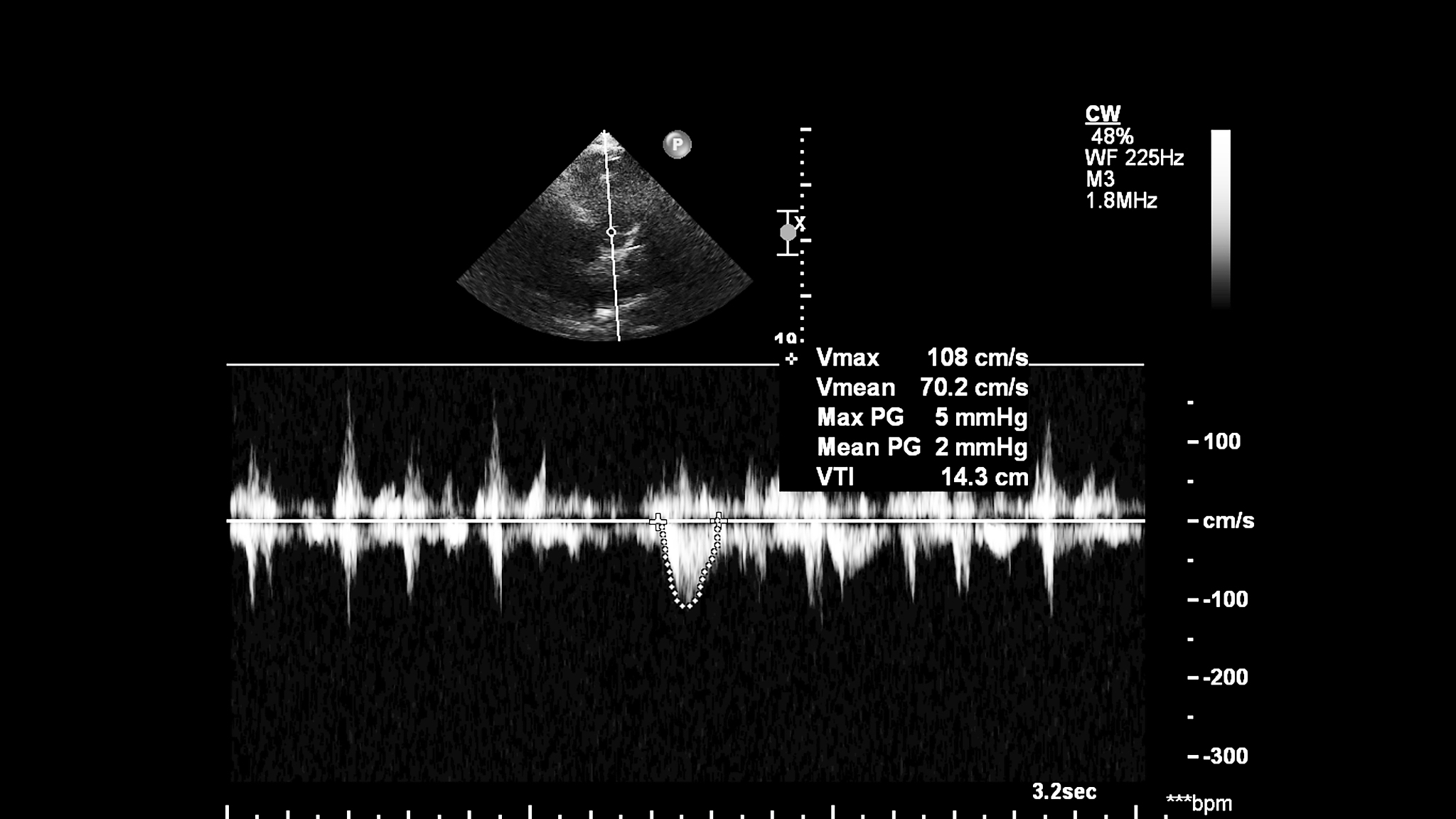 心电信号降噪与滤波实验分析