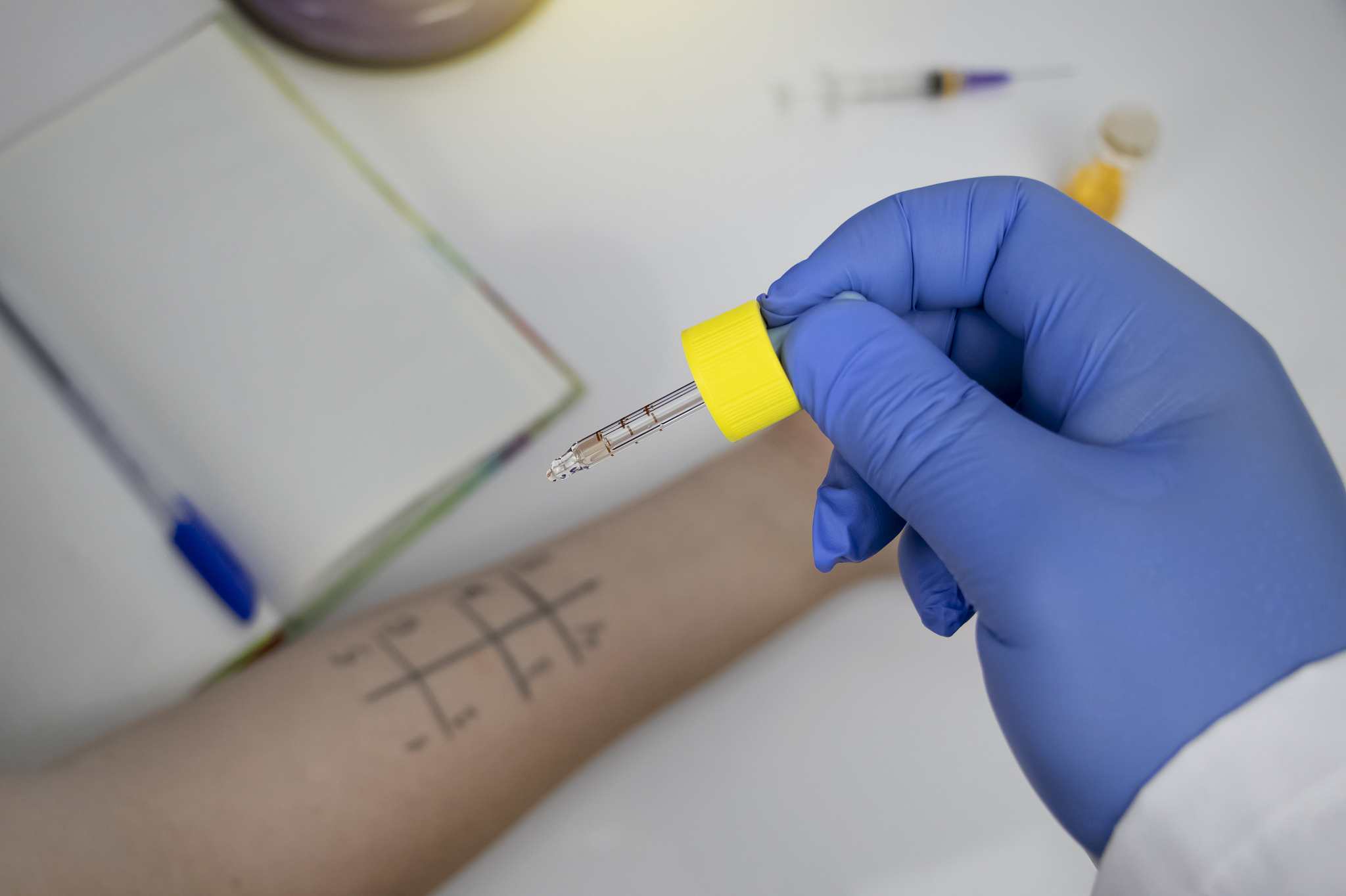 喝牛奶会加重荨麻疹吗