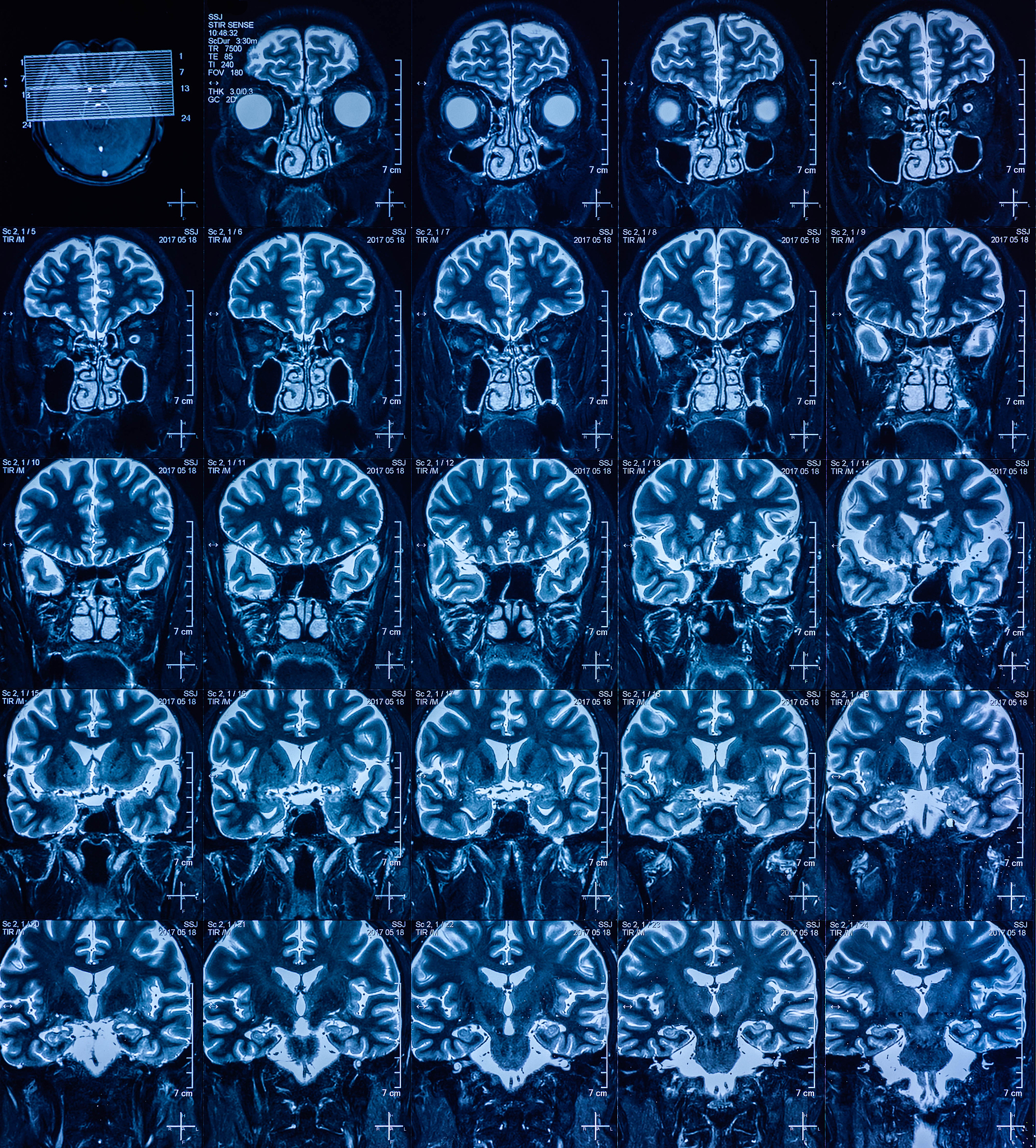 MICCAI Brainlesion Workshop 中文介绍：脑病变图像分析领域的顶级盛会