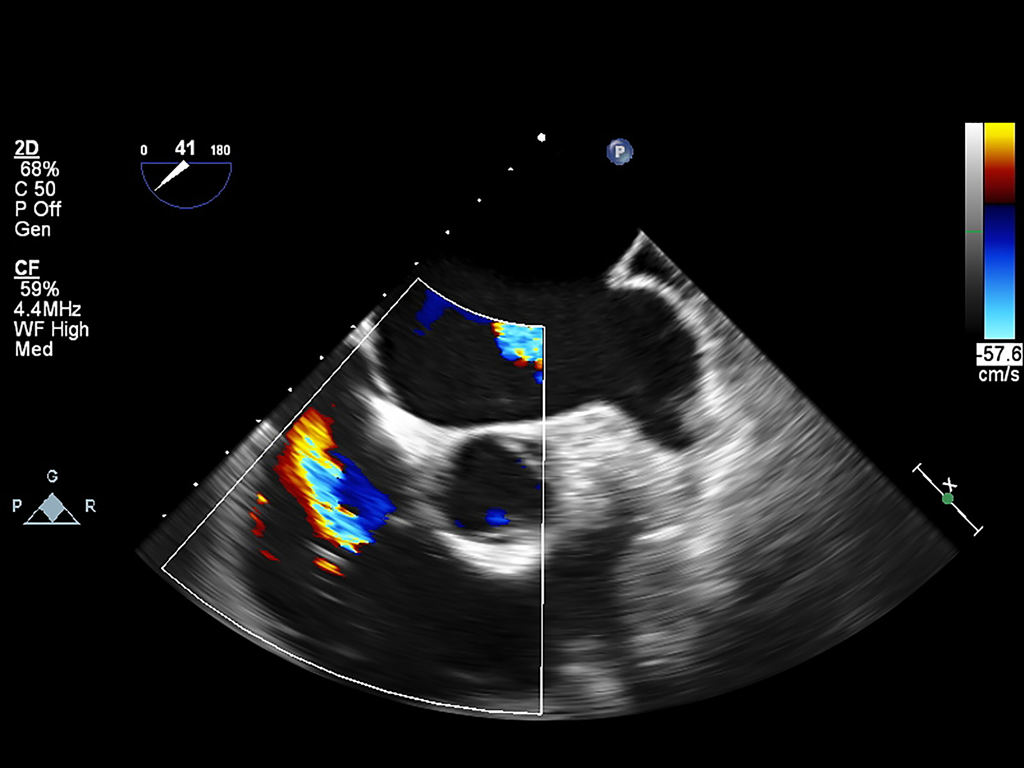 超声造影：揭示传统超声难以发现的斑块溃疡