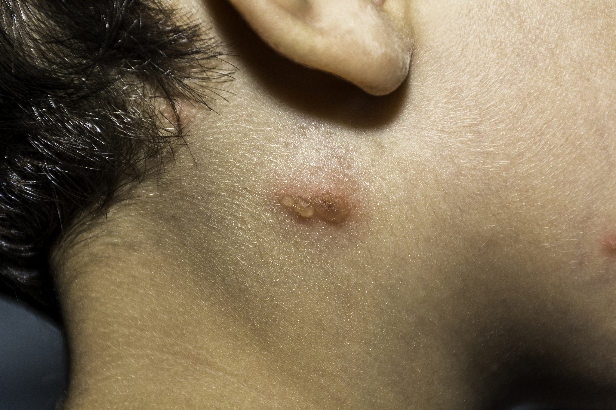 close up shot of varicella virus or chicken pox bubble rash on c