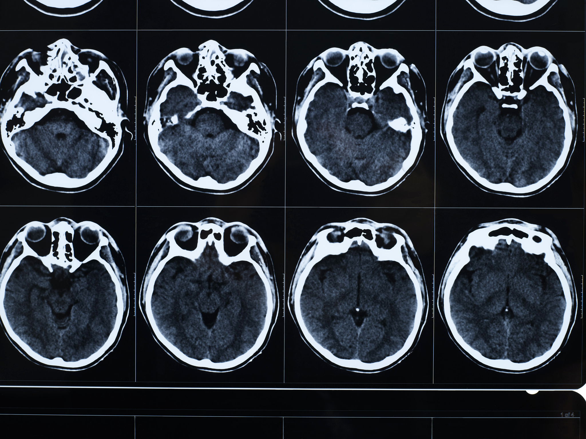 我的论文是《腺泡样软组织肉瘤的CT、MR特征分析》请在中国知网检索相关文献并按照概述、资料与方法、结果、讨论的框架完善其中的概述部分并添加引用文献不少于500字