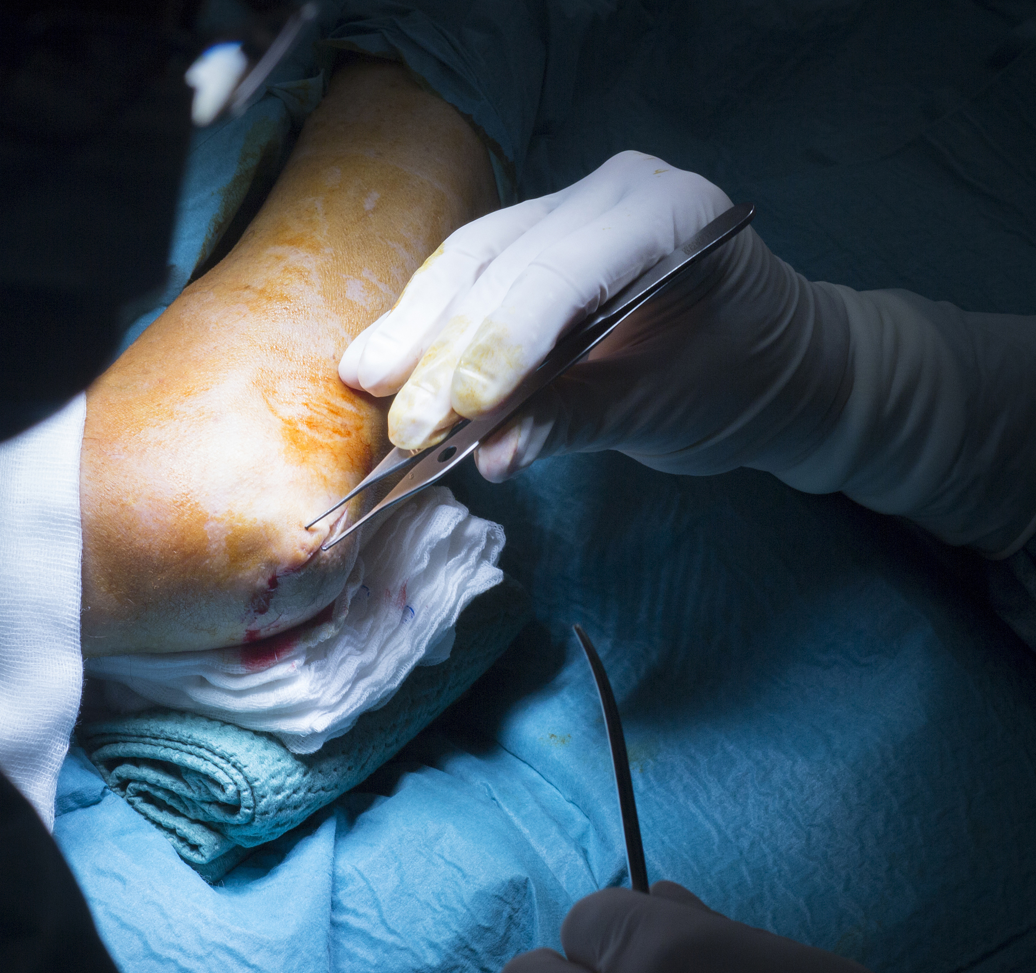 全关节镜下修复距腓前韧带损伤治疗效果 - 恢复稳定性和功能