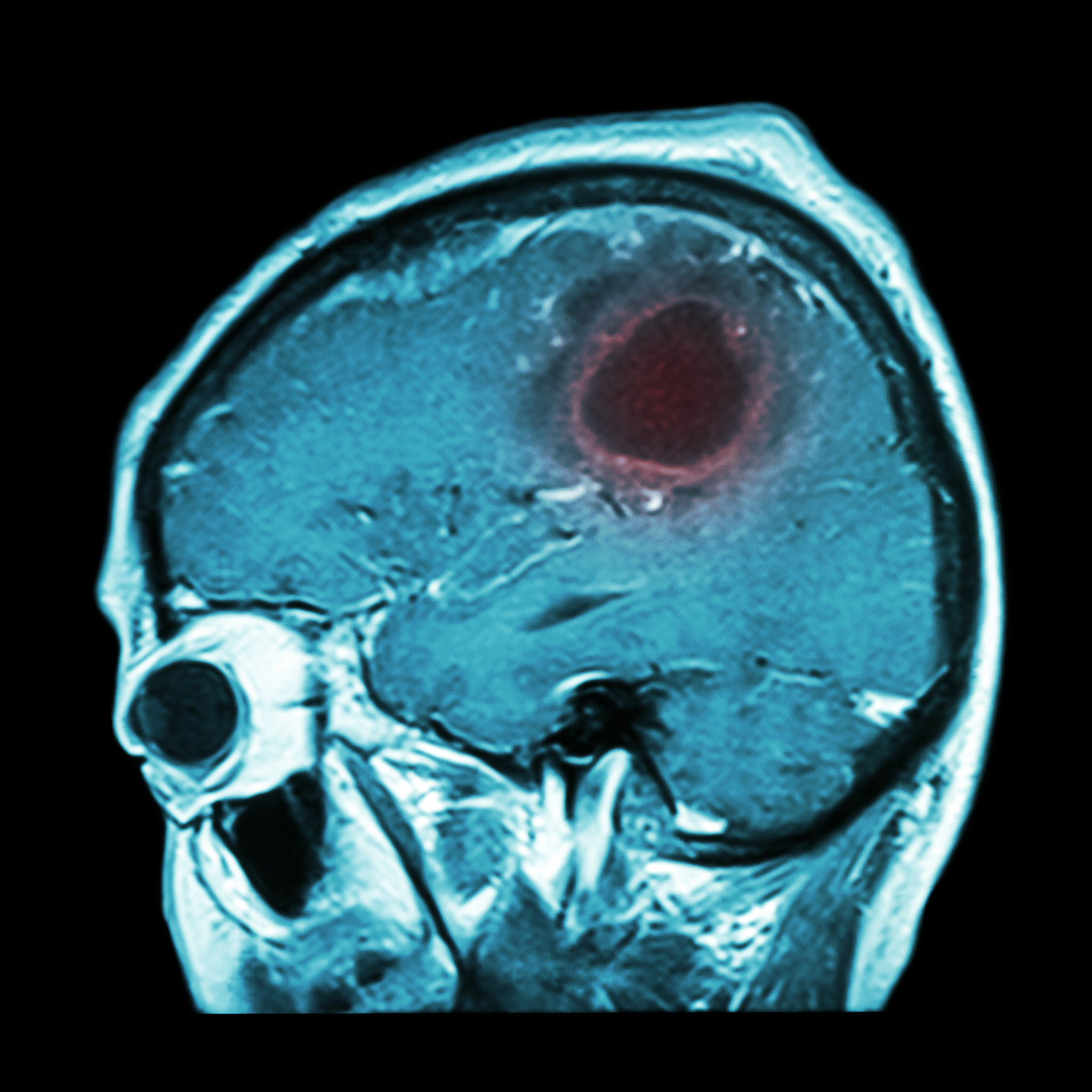 腺泡样软组织肉瘤 (APT) 的 CT 和 MR 影像学特征分析