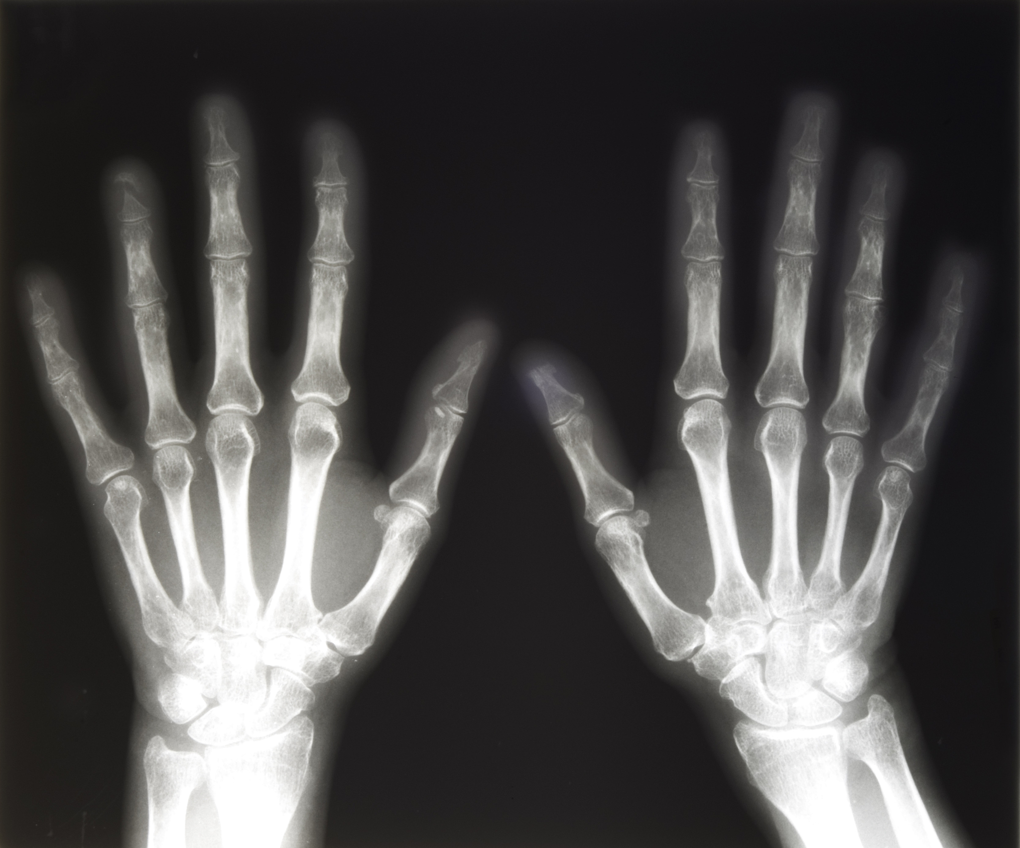 骨龄预测方法：传统方法及优缺点