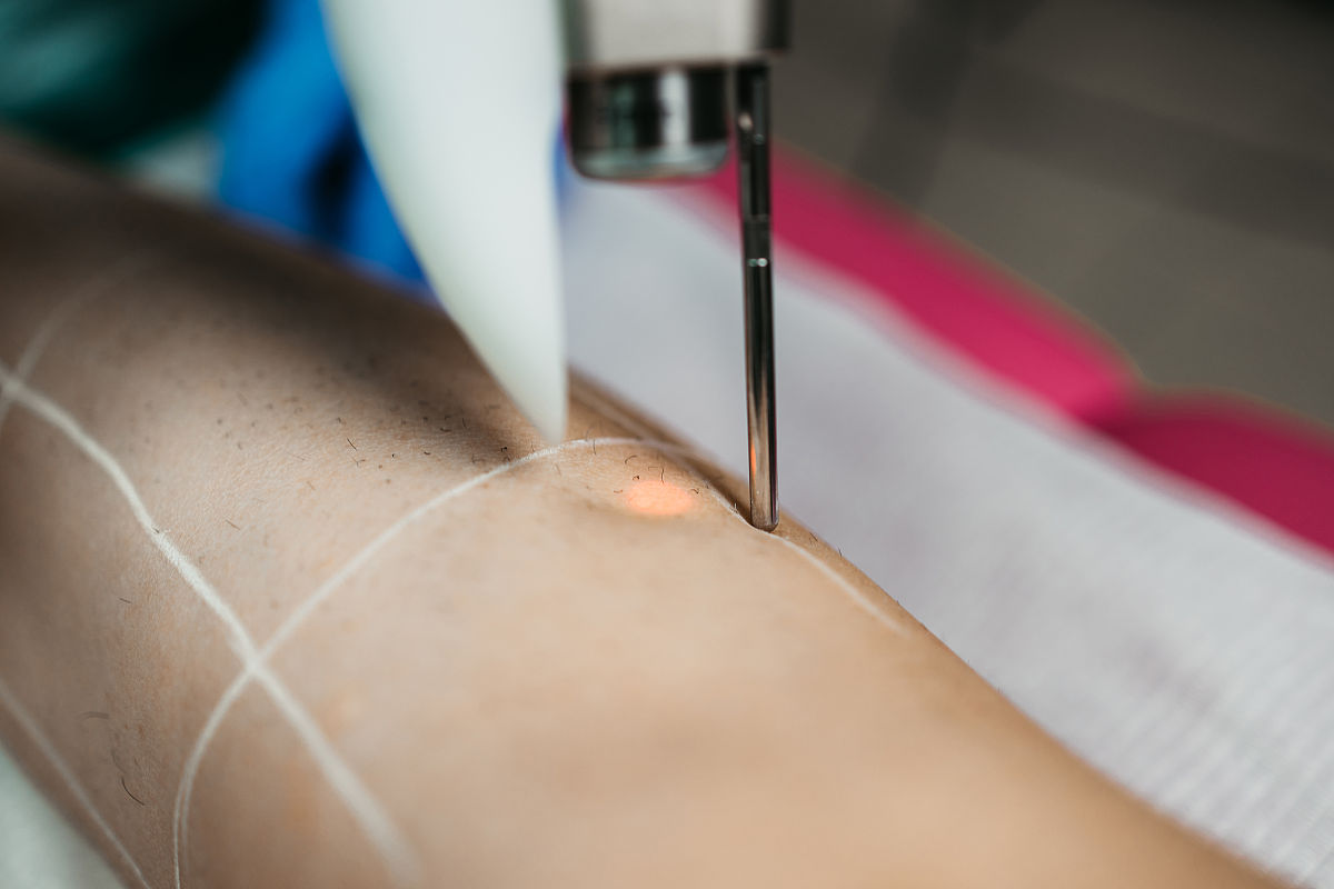 永久去除阴毛：方法、风险和注意事项