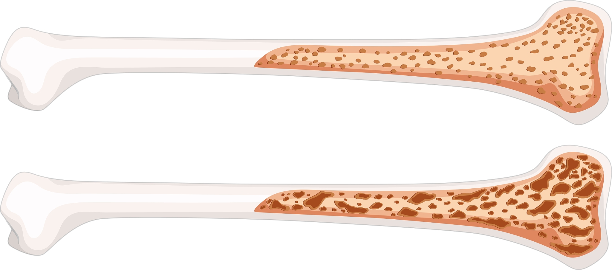 骨可塑性: 你的骨骼比你想象的更灵活