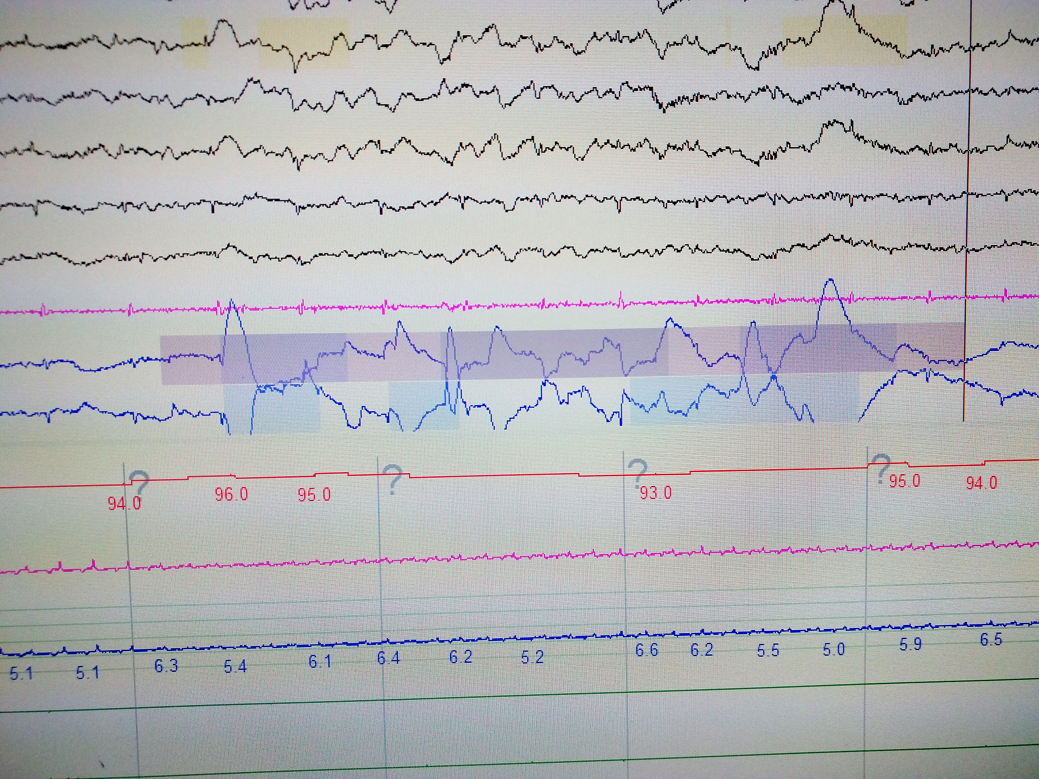 脑电活动：皮层紧张与睡眠表现