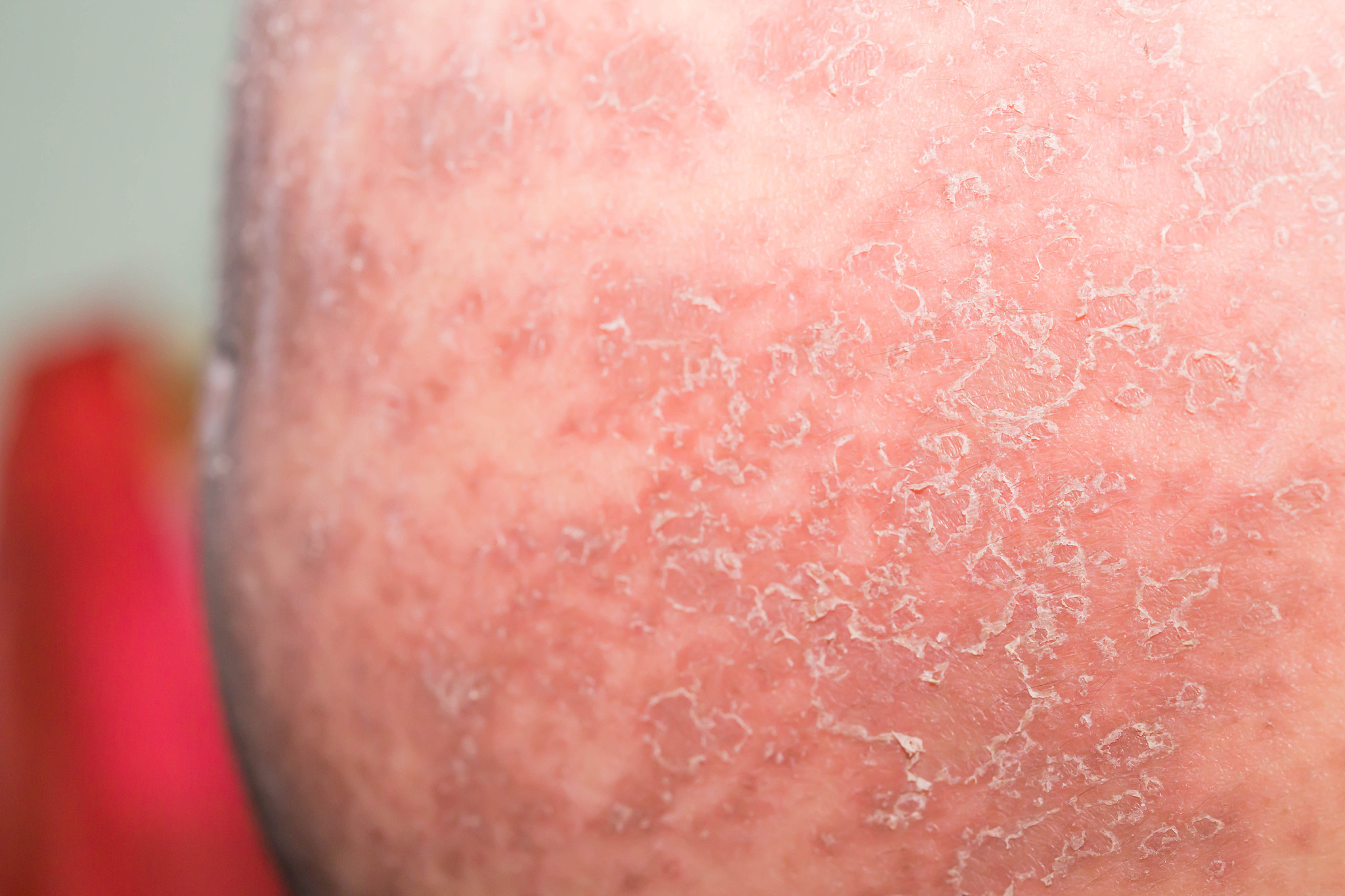 肚子脱皮是什么病严重吗