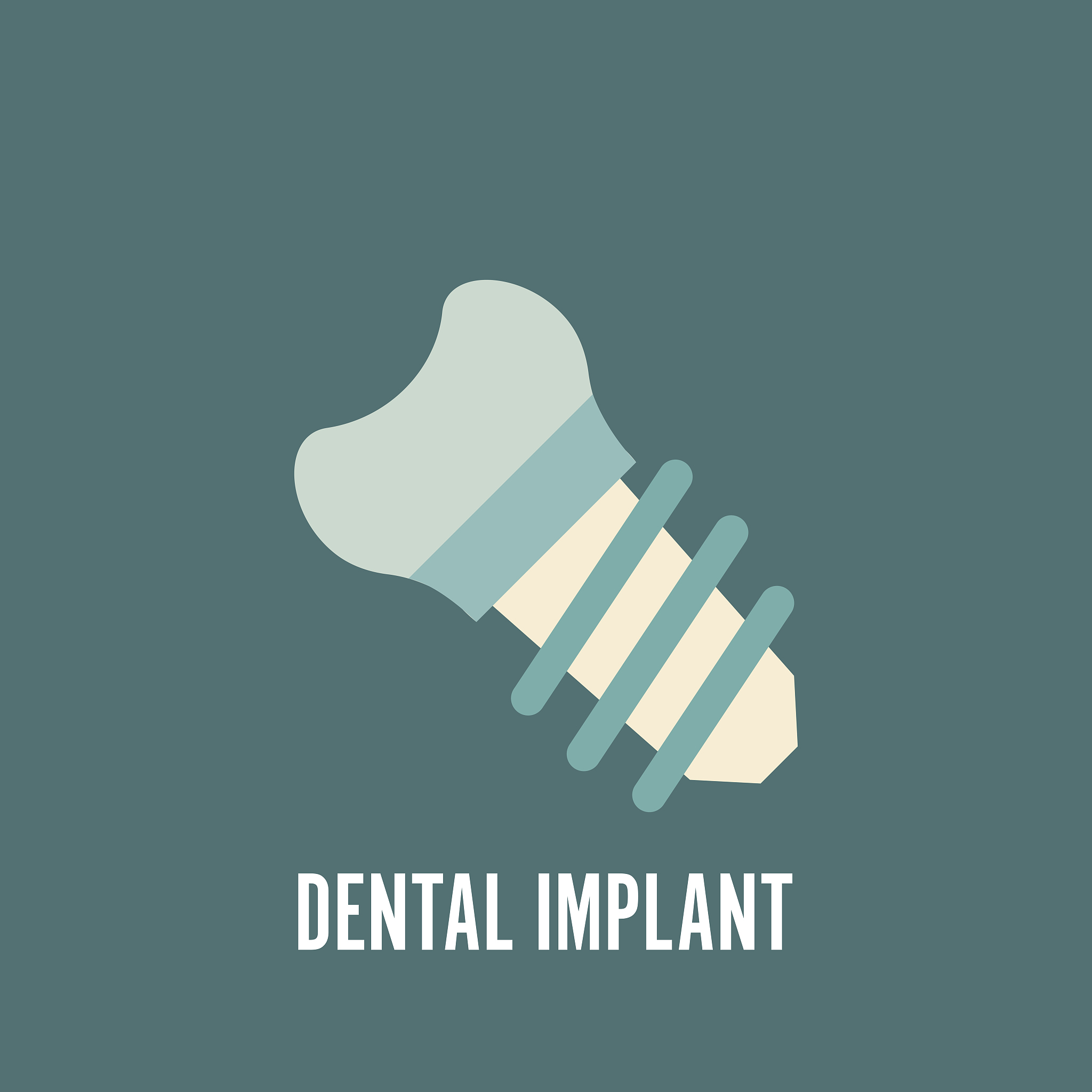 口腔种植学中生物力学方法的应用与未来展望