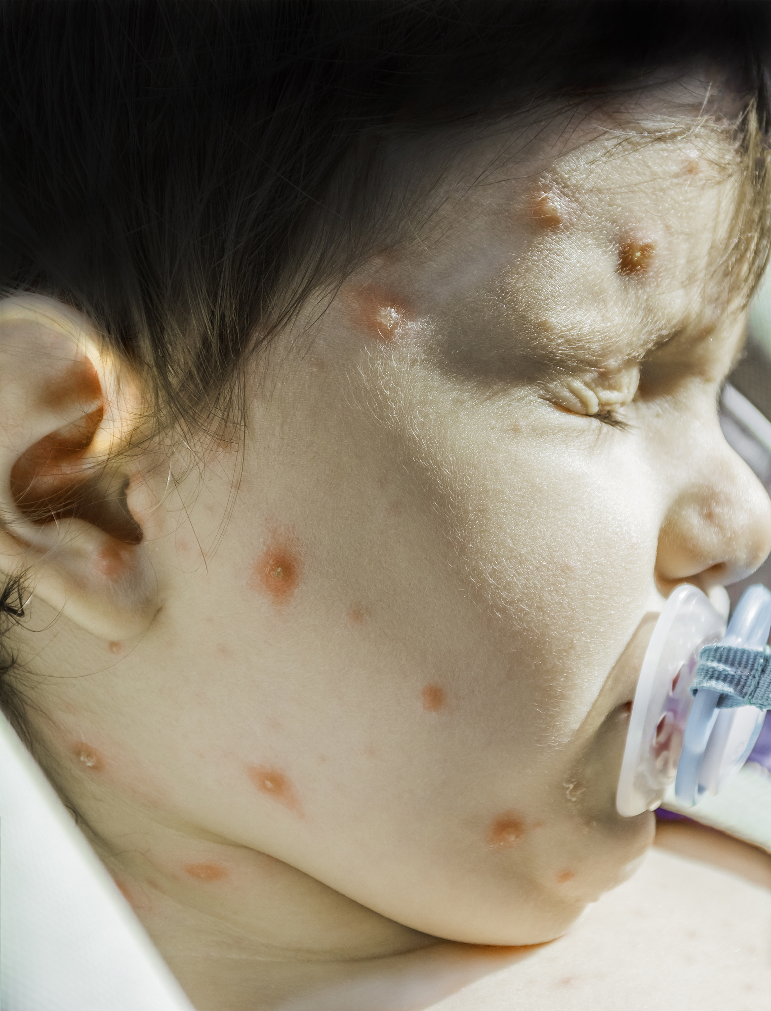 close up shot of varicella virus or chicken pox bubble rash and 