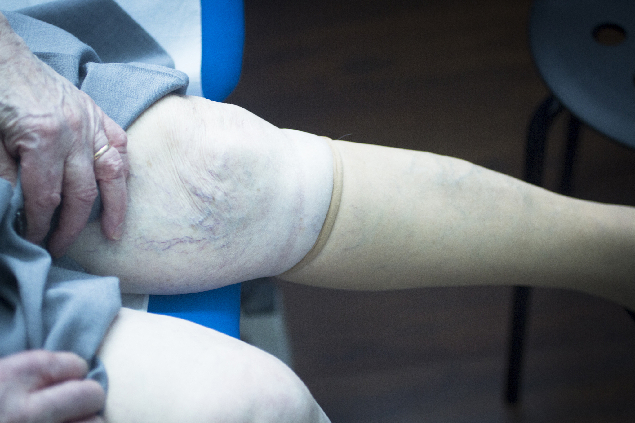 全身多发性骨折：症状、治疗和康复