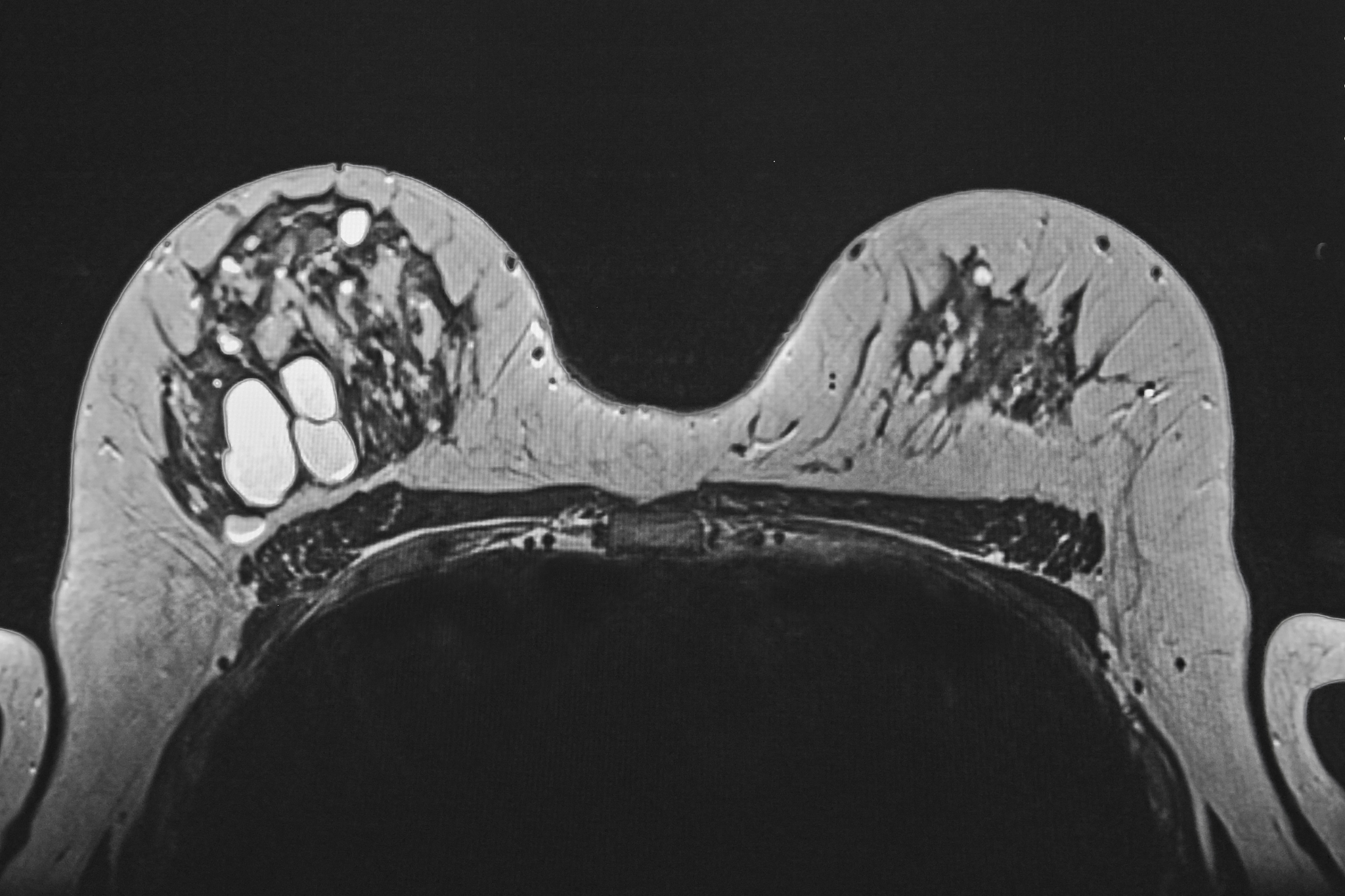 患者女29岁因突发下腹痛2小时入院。急诊CT诊断描述如下：右下腹附件区可见团块状异常密度影范围约6782cm其内部密度不均平扫CT值约9-72HU病灶边界欠清病灶周围可见增粗的血管影盆腔内可见积血积液子宫受压左偏；左侧附件区无殊。请根据以上CT影像描述给出可能的诊断结论。