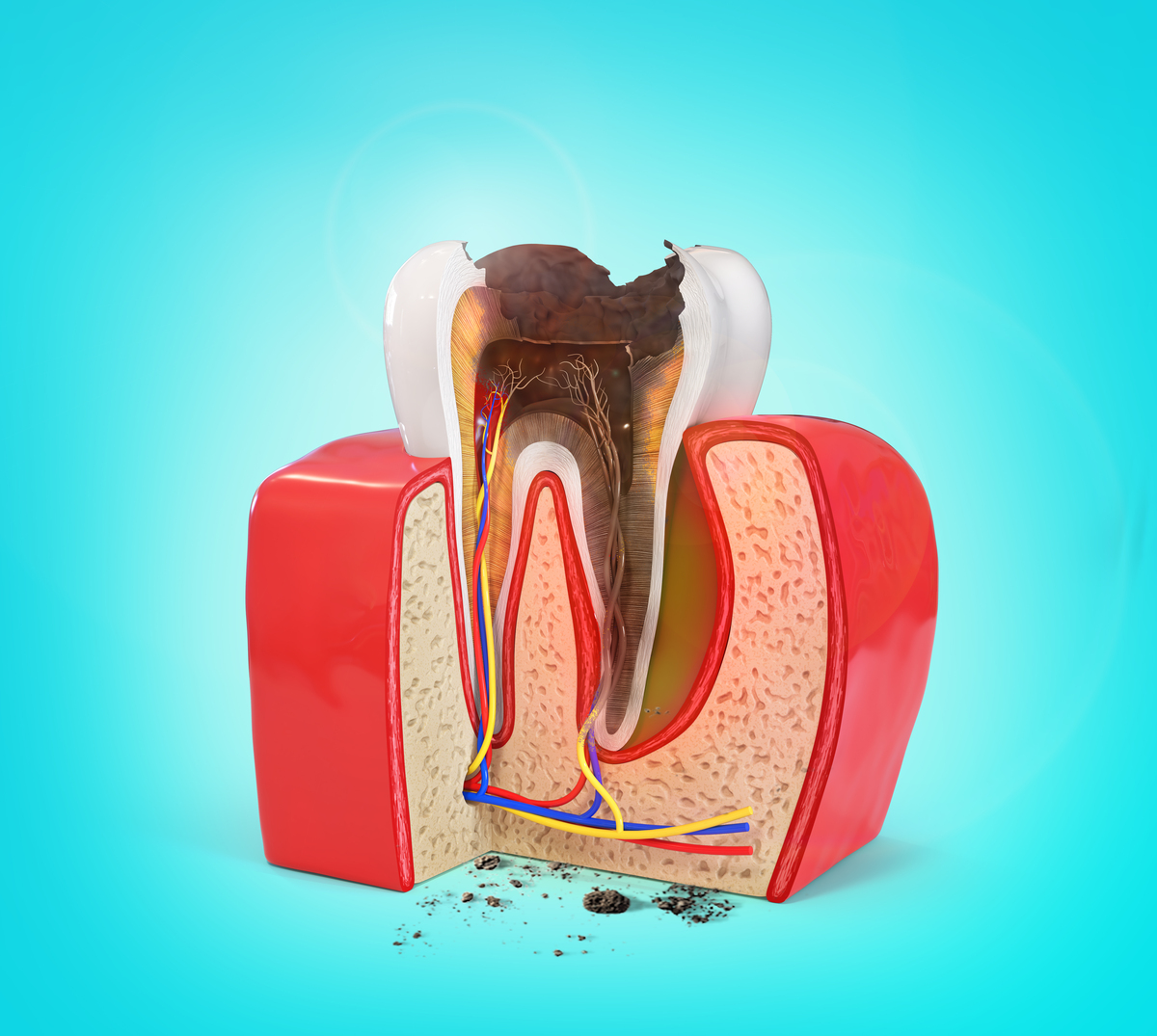 根尖屏障术：保留牙齿，恢复口腔功能