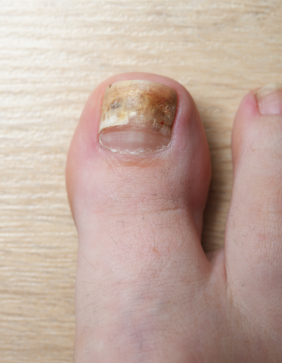 灰指甲原因：全面概述 - 了解灰指甲的常见原因