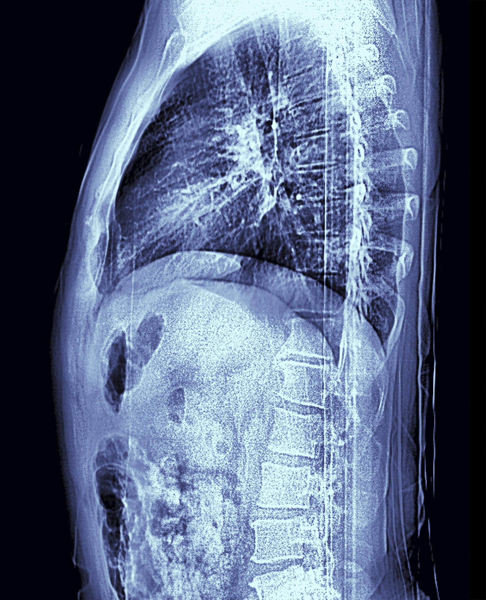 关于腺泡状软组织肉瘤的CT和MR表现方面有哪些文献要求英文推荐10篇并总结文献的内容生成中文文字