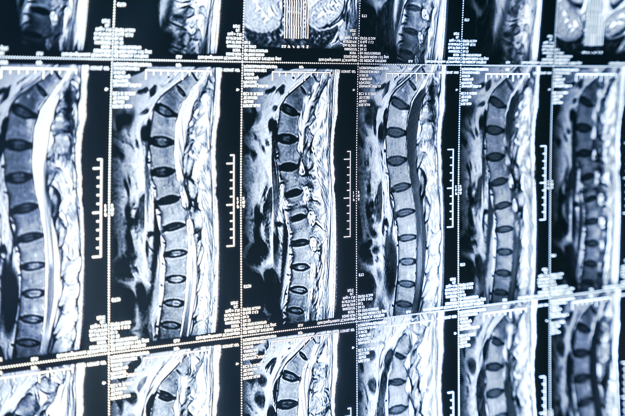 颈椎 MRI 图像生成：线性噪声方案为何更优？