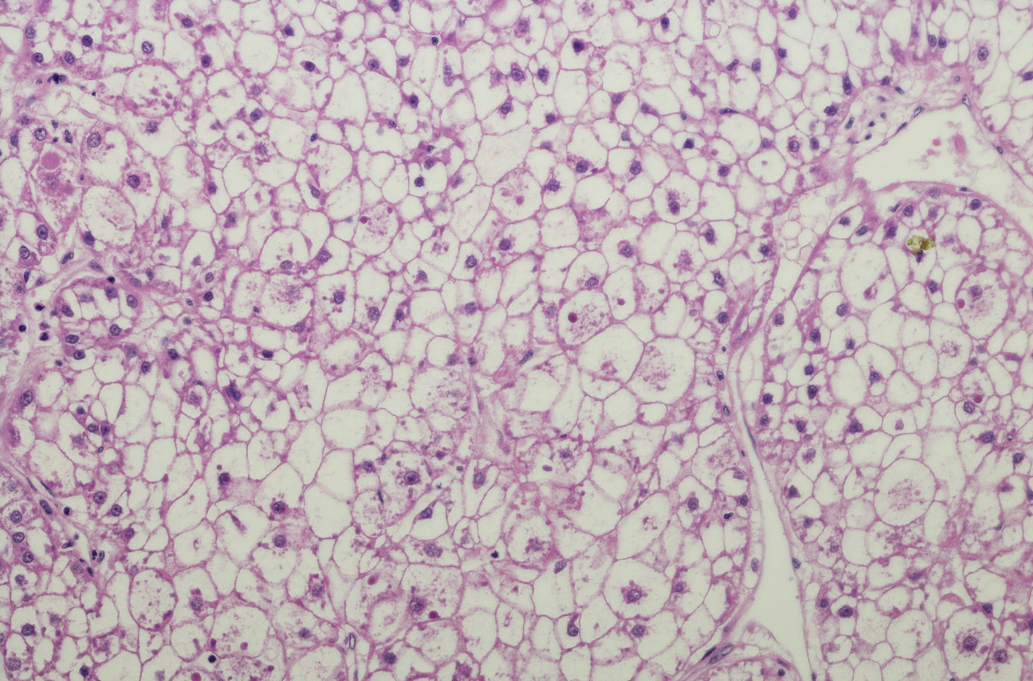 肝炎是如何发展成肝癌的