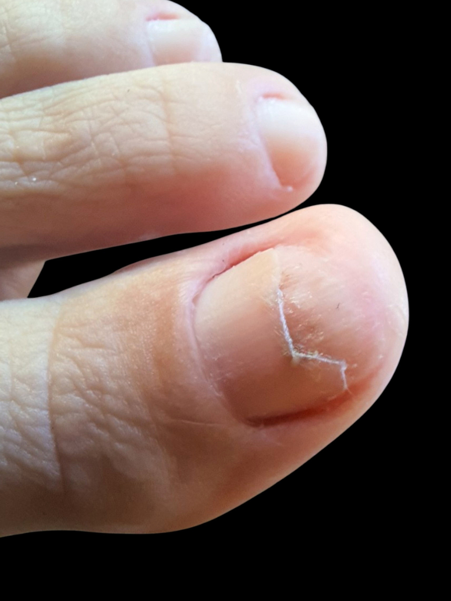 脚指甲长进肉里怎么办？有效解决方法及预防措施