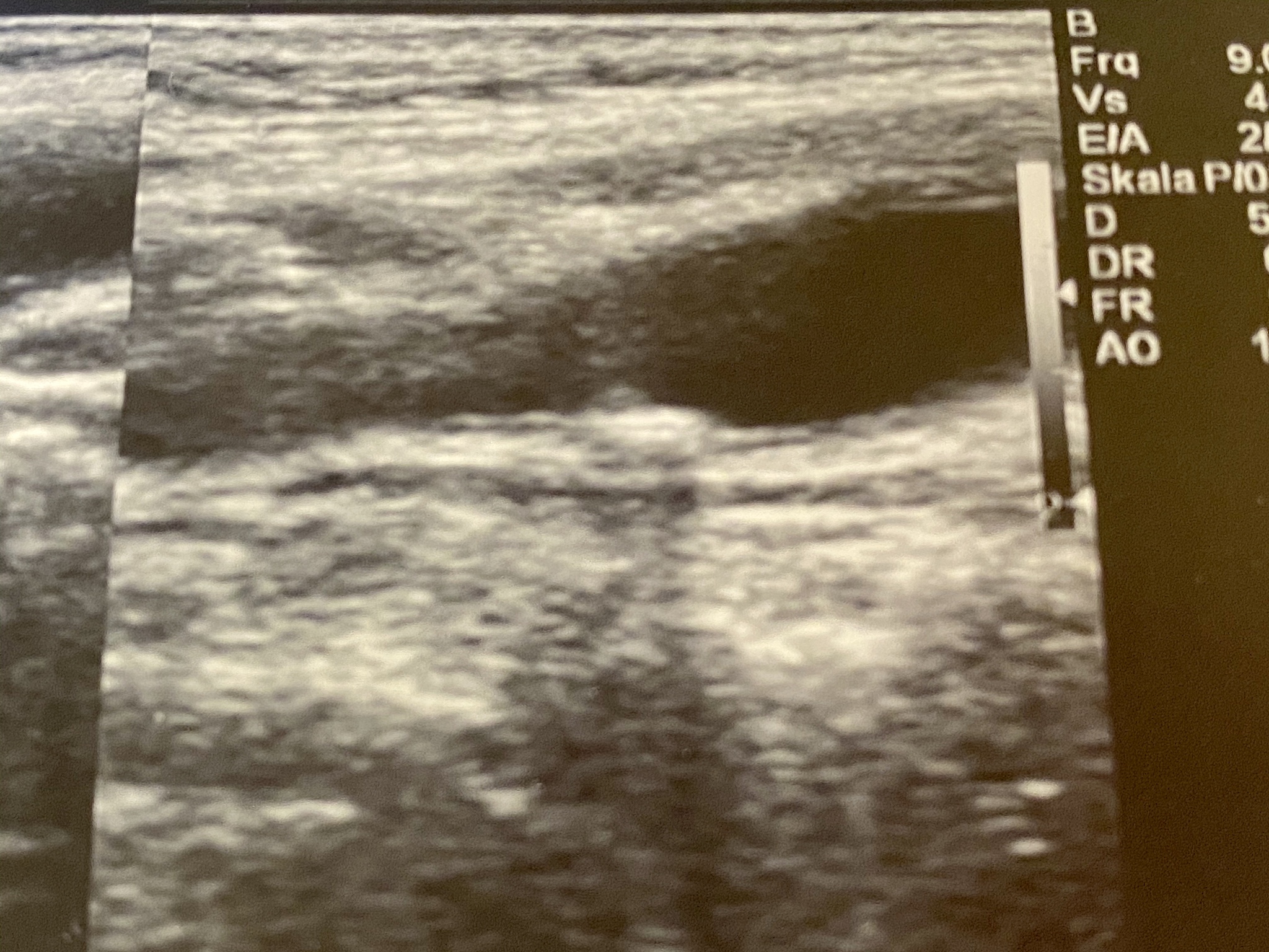 超声检查发现斑块表面纤维帽局部中断，伴随低回声附着物