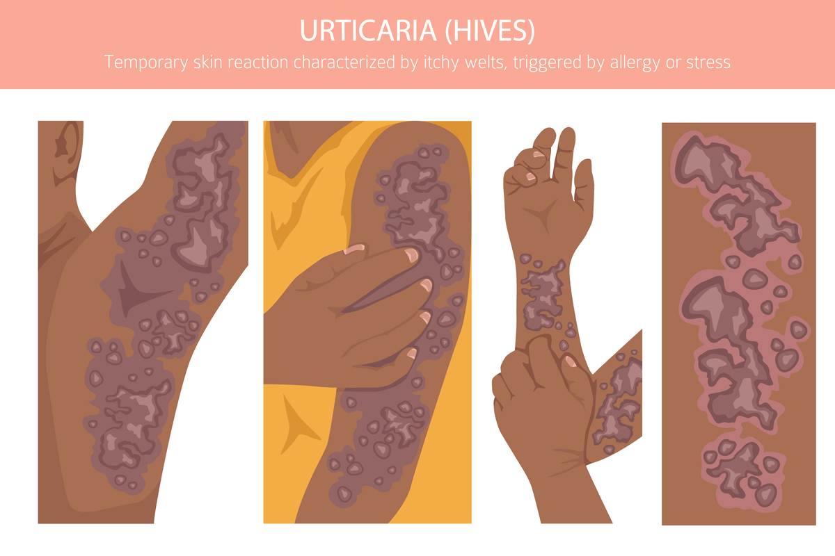 慢性自发性荨麻疹的主要致病抗体：IgE抗体