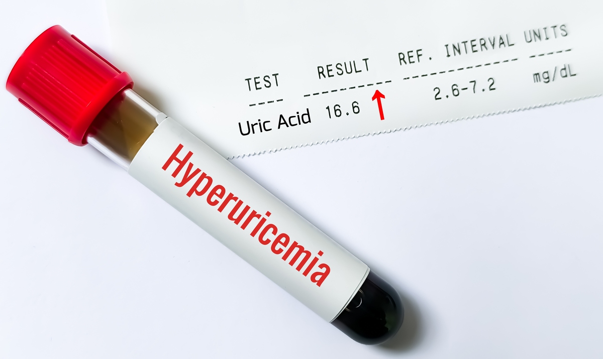 尿酸高怎么办？降尿酸方法及注意事项