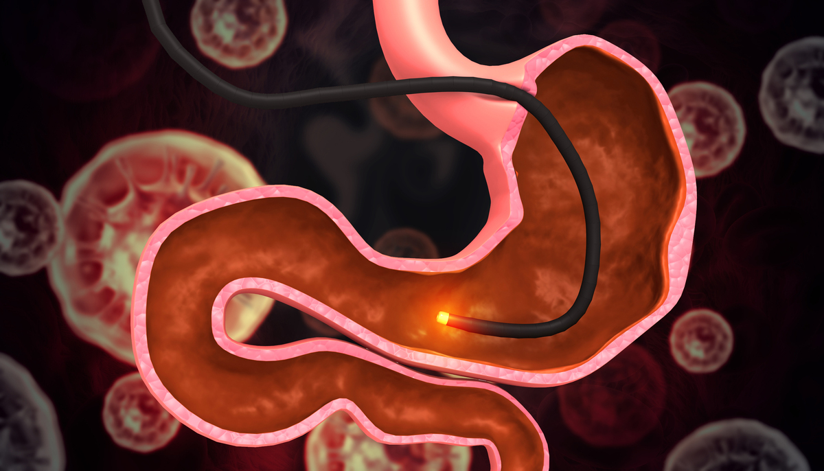 请对毕业论文《胃癌患者术后早期护理支持对胃癌患者术后早期康复的作用》12关键词定义121 胃癌患者 122术后早期 123 护理支持 124早期康复 124作用 进行写作不要乱写：