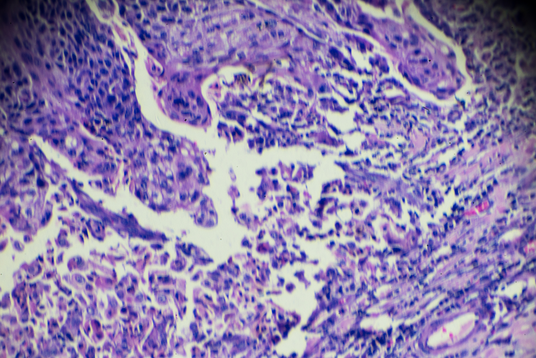 食管癌并发食管胃支气管瘘：护理指南与注意事项