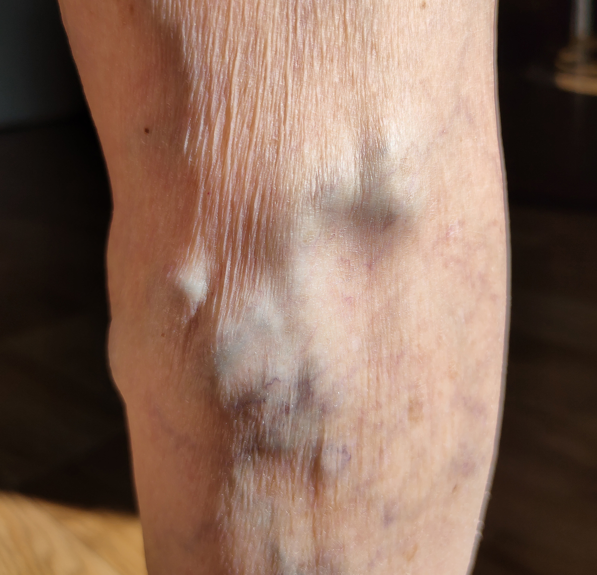 静脉曲张 病因 症状 预防 500字 专家级