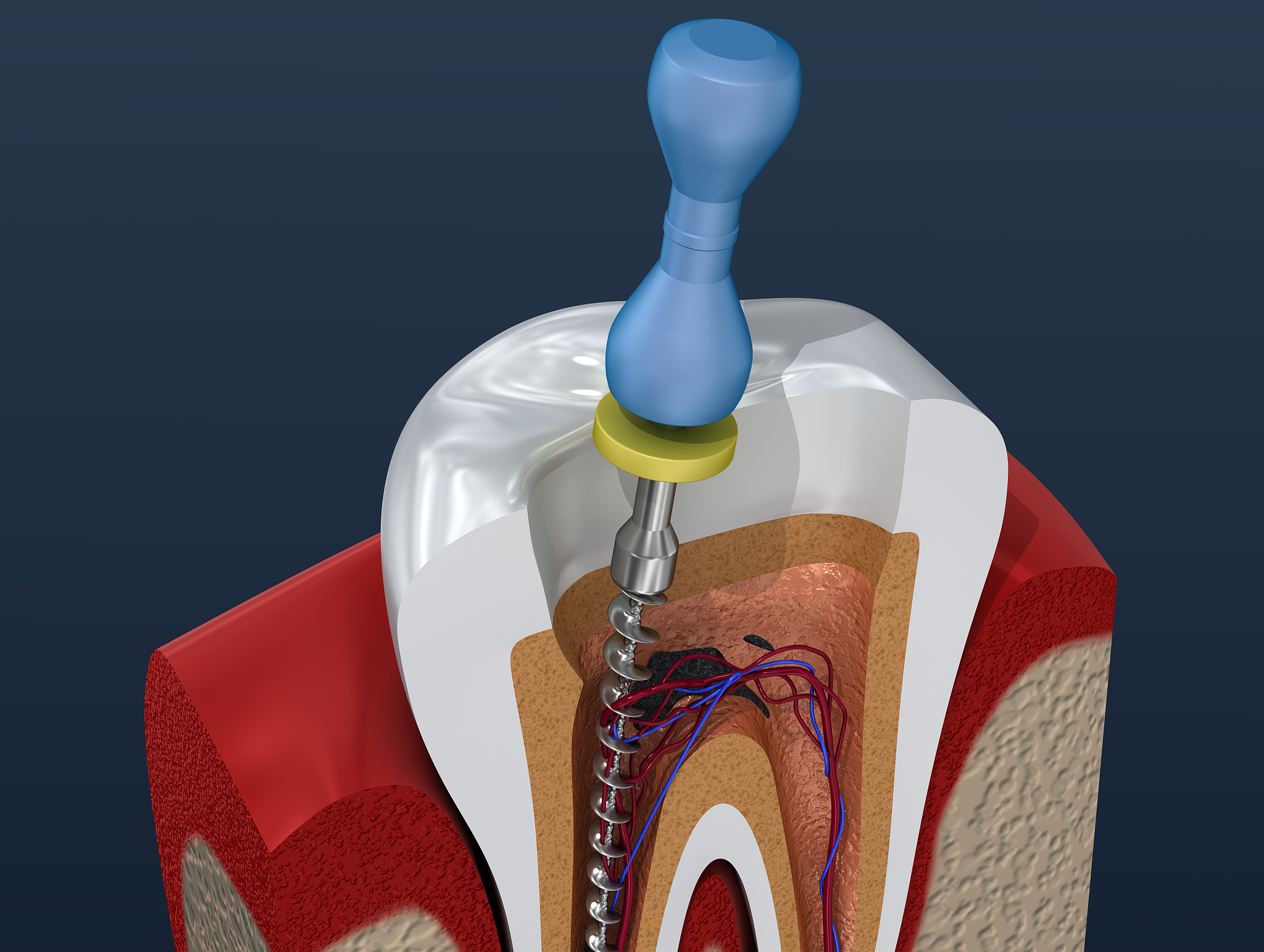显微根管治疗方案：步骤详解及注意事项