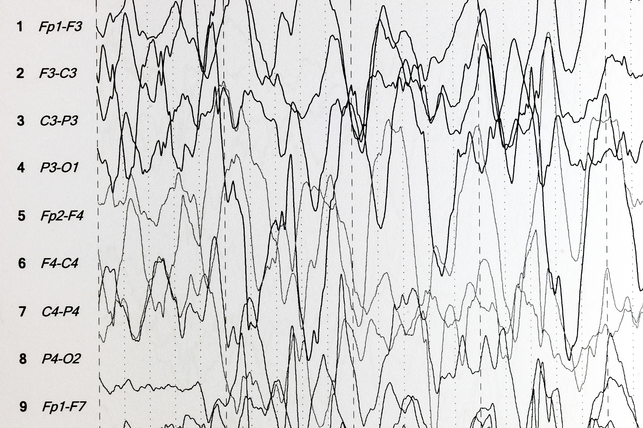 癫痫持续状态：体征监护要点详解