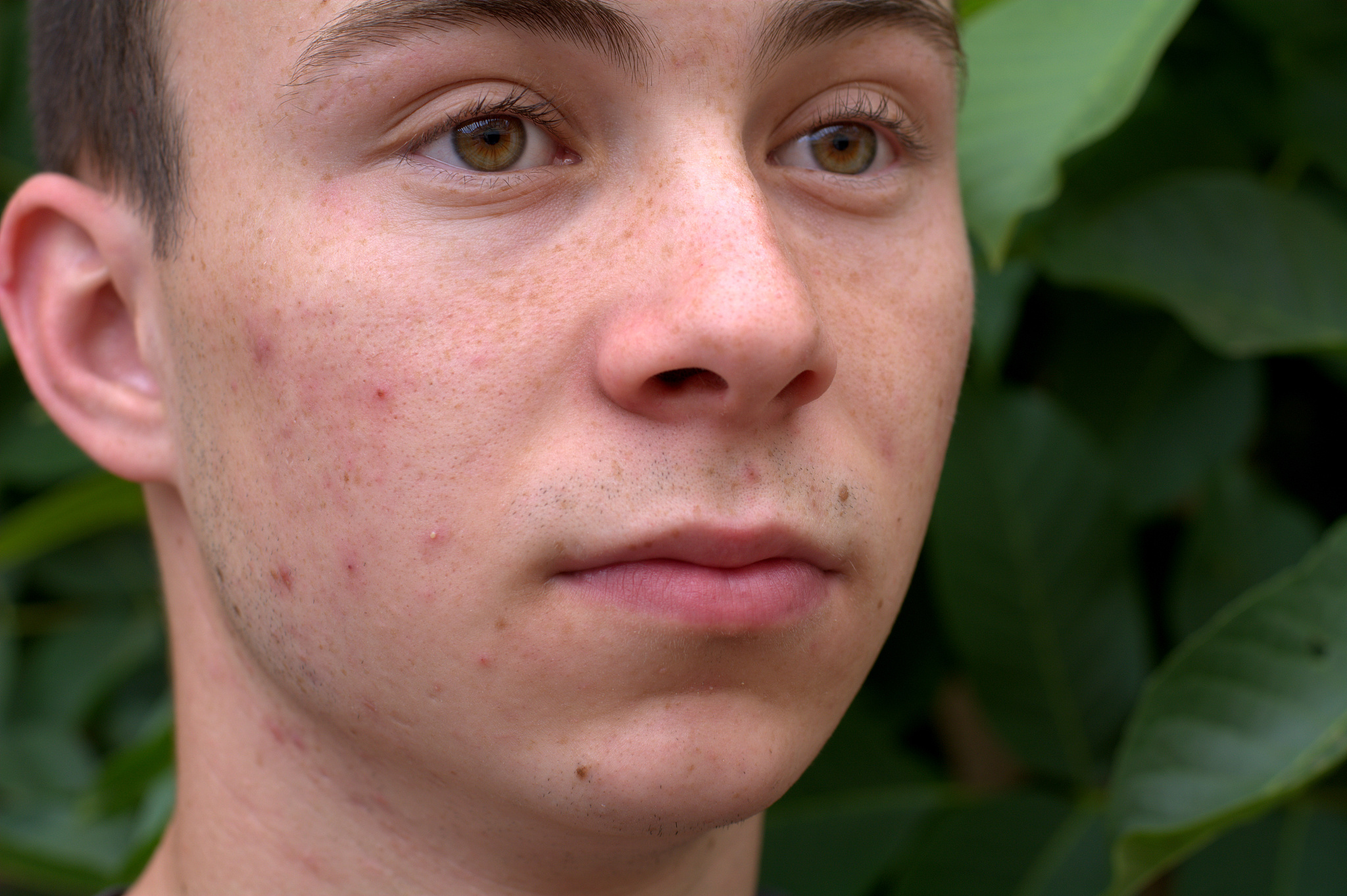 teen boy with acne on his face