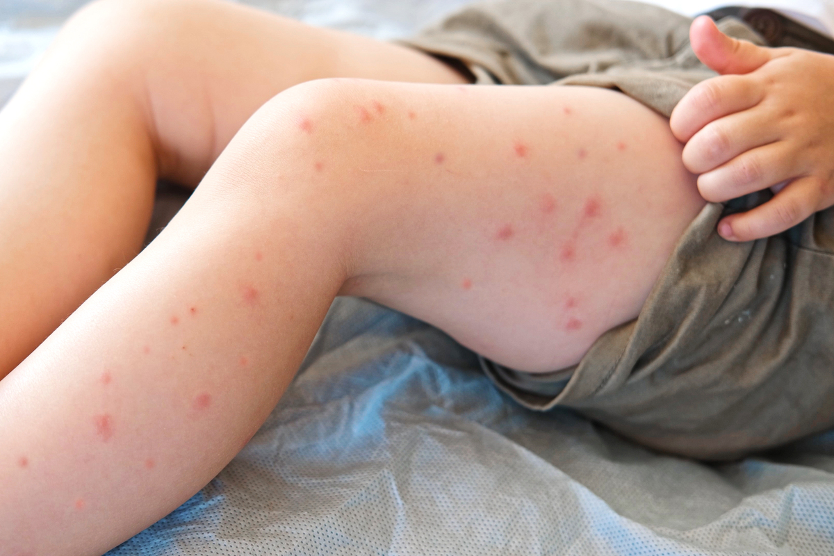 手臂上出现很多小红点是虫子咬的吗