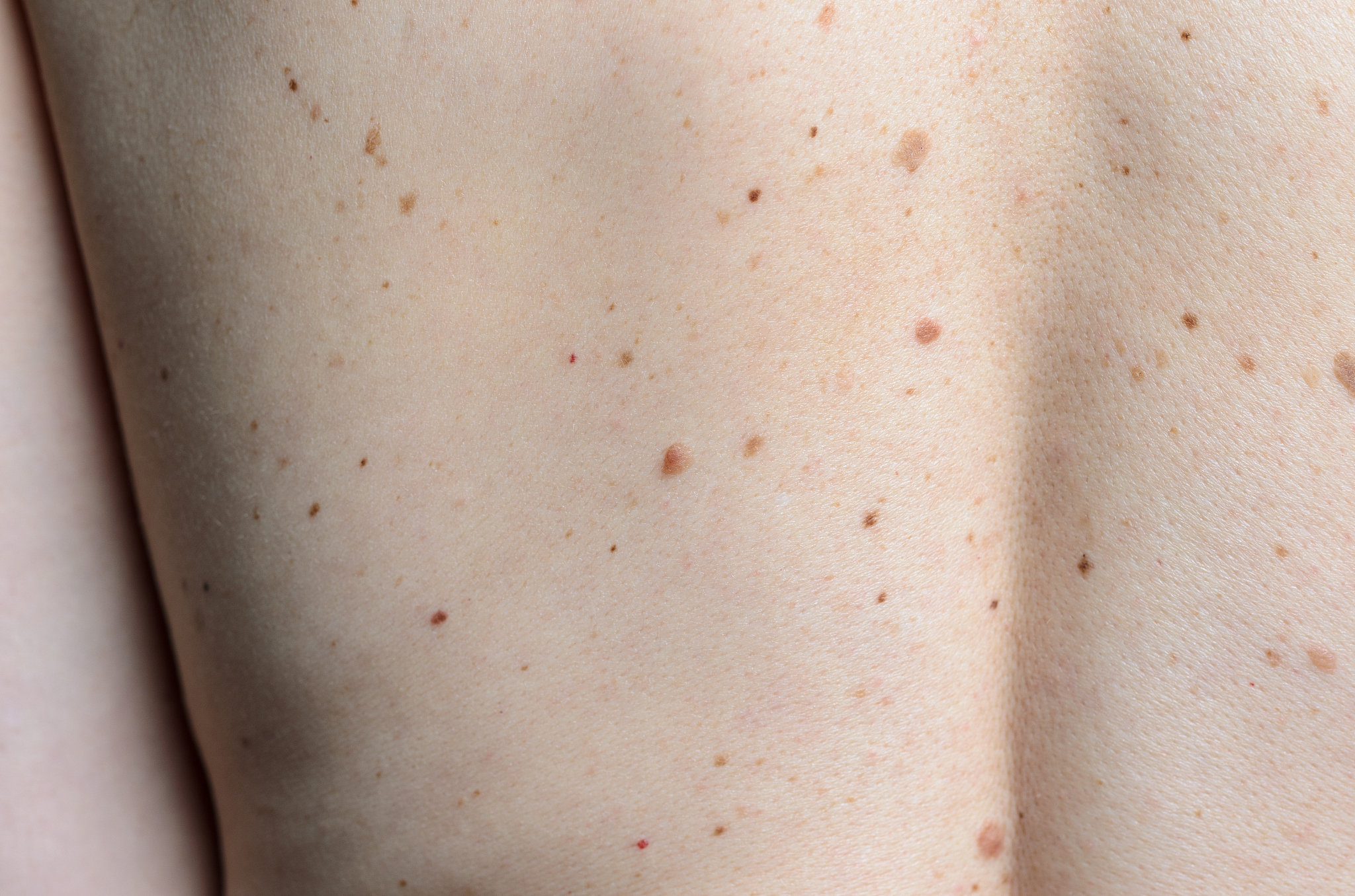 skin on a womans back with moles