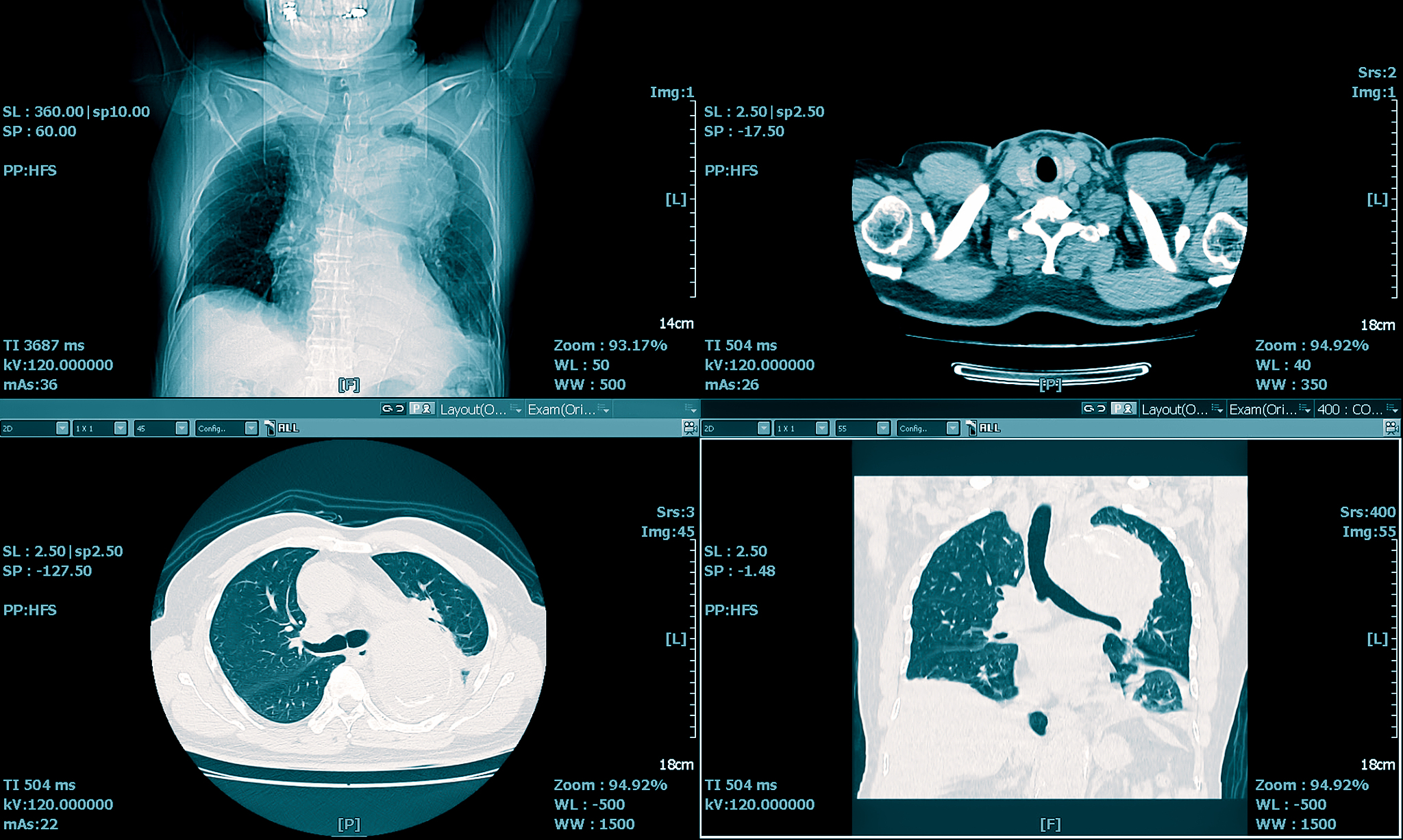 乳腺成像时一般采用较软的 X 射线。该射线透过乳腺时最可能发生以下哪种现象： a特征辐射；b连续辐射；c韧致辐射；d光电效应。