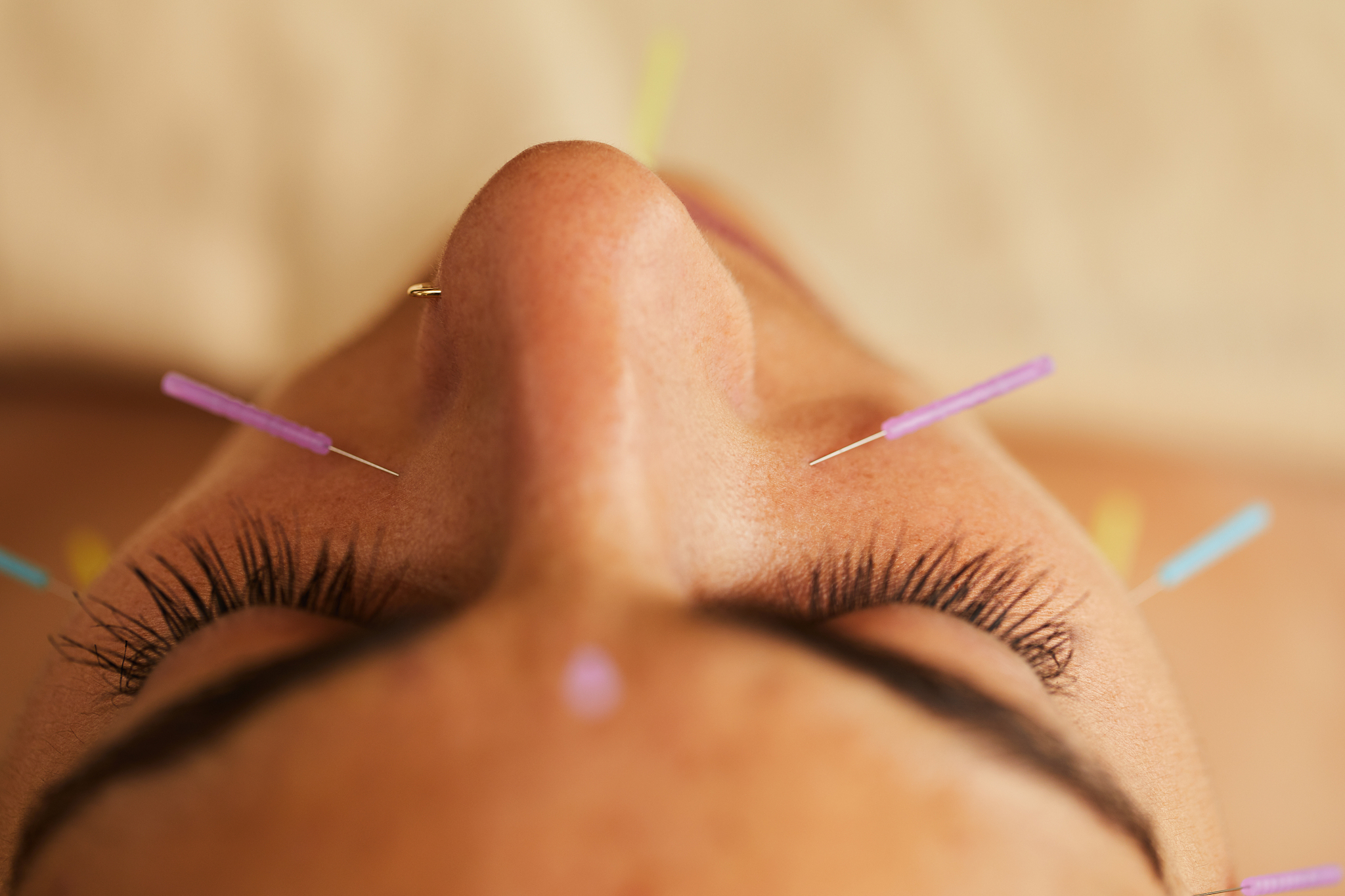 young woman having an acupuncture session on her face