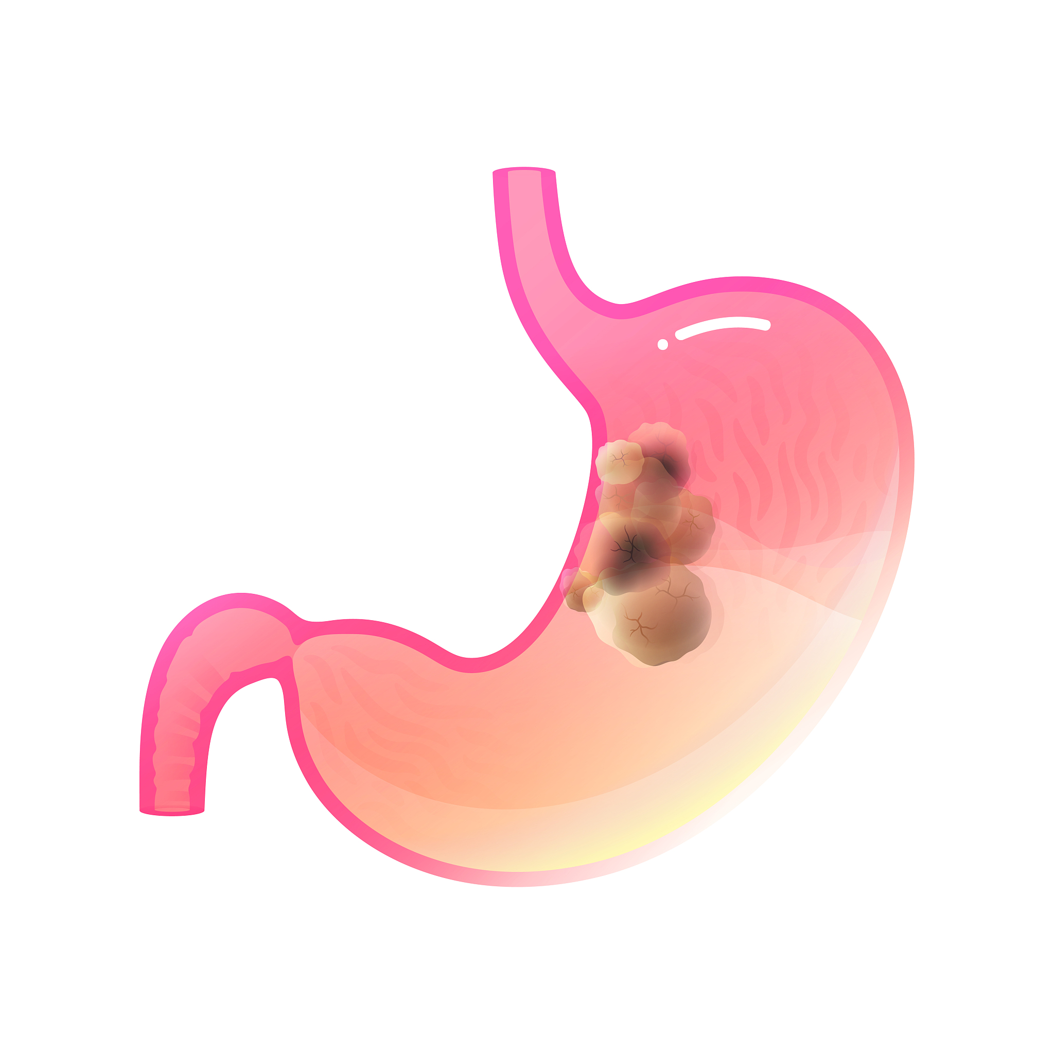 胃癌晚期生存期：了解预后和治疗方案