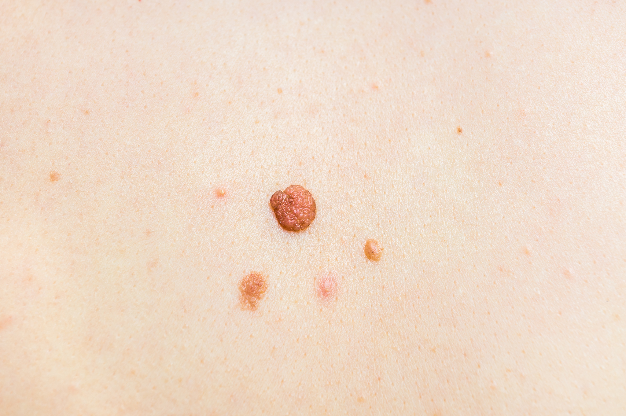 woman with birthmark on her back, skin tags removal