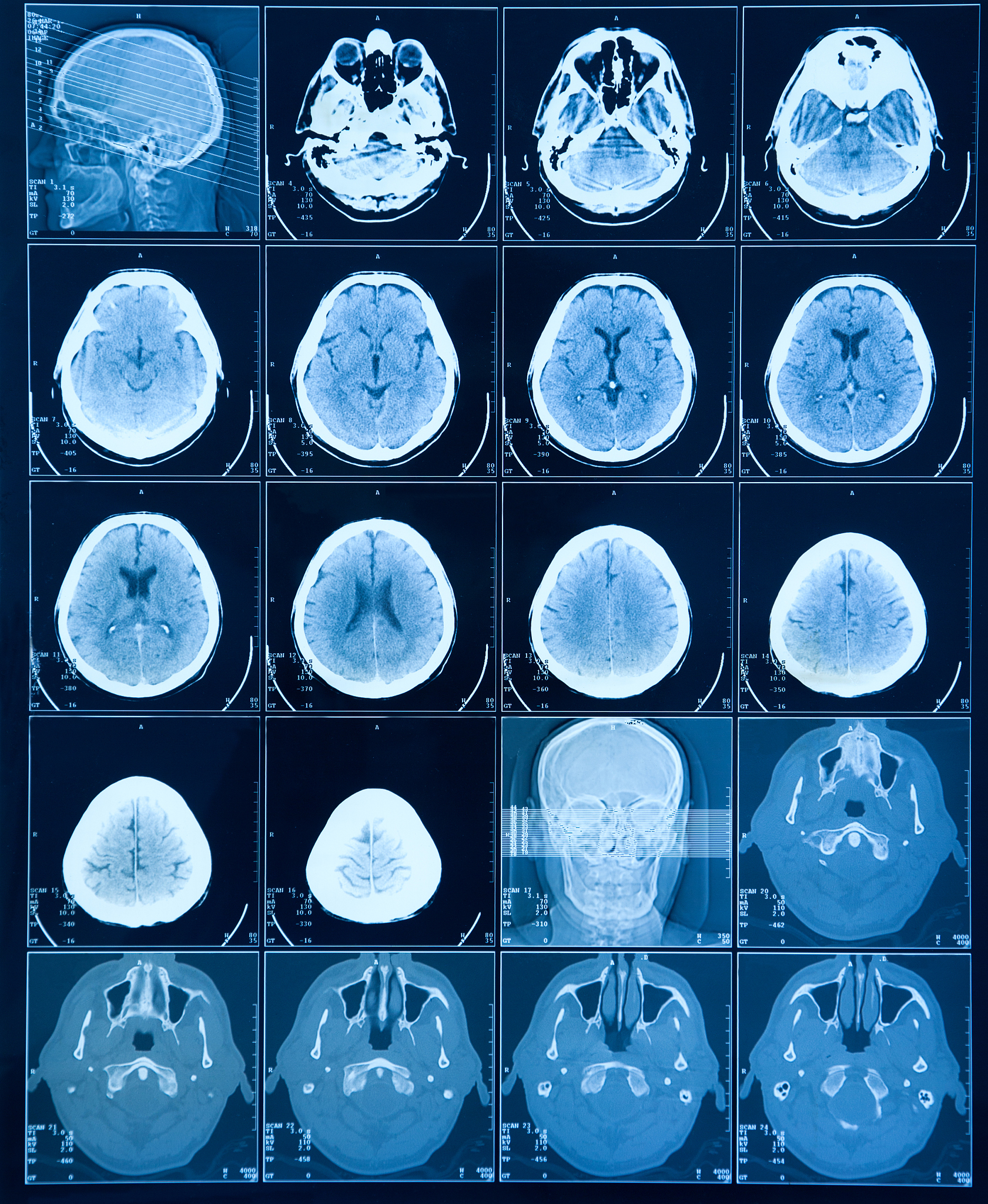 CT Image Ground Truth: Black for Background, White for Tumor
