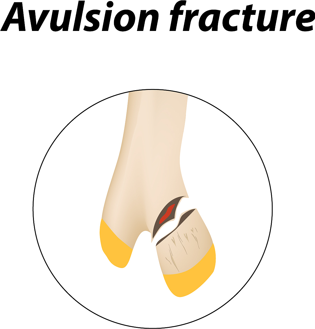 高龄股骨粗隆间骨折的骨质疏松原因分析