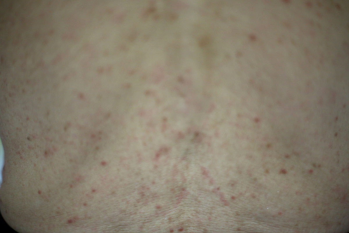 后背长痘痘的原因及治疗方法