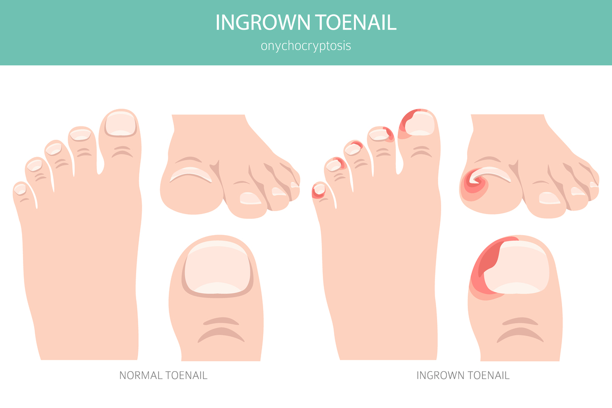 脚趾弯曲会疼是怎么回事？