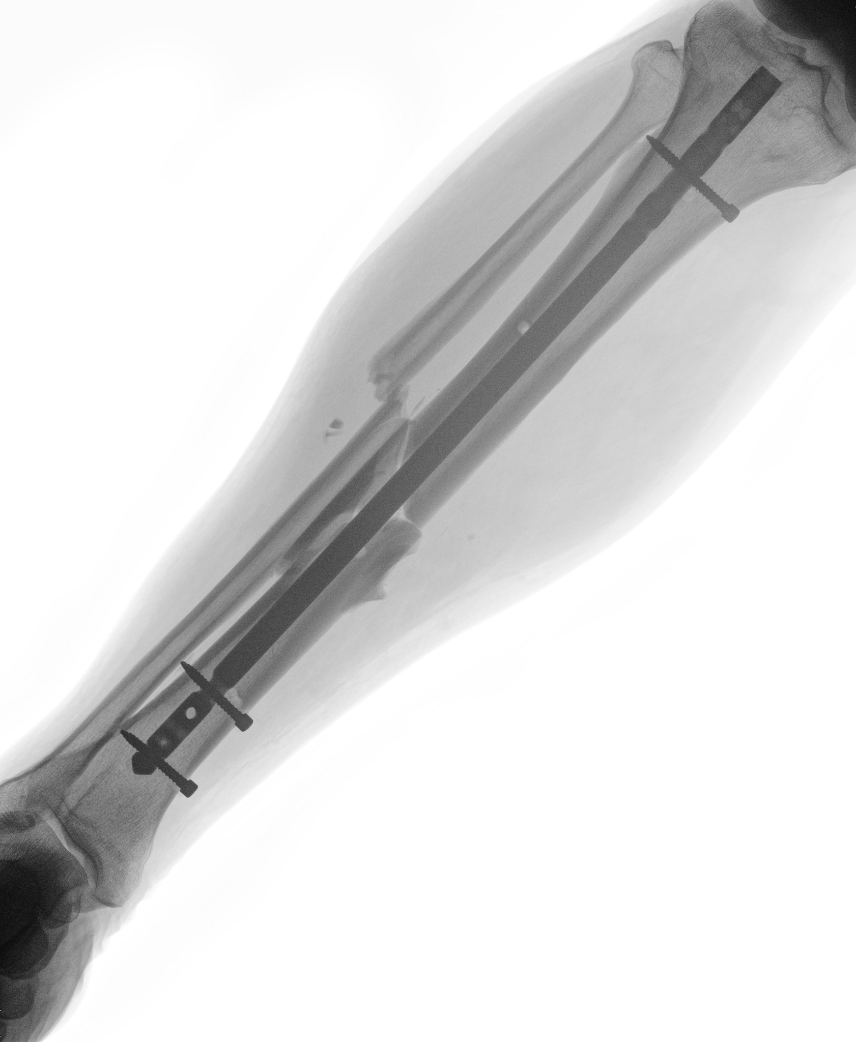 全关节镜下修复距腓前韧带损伤疗效观察文章讨论部分