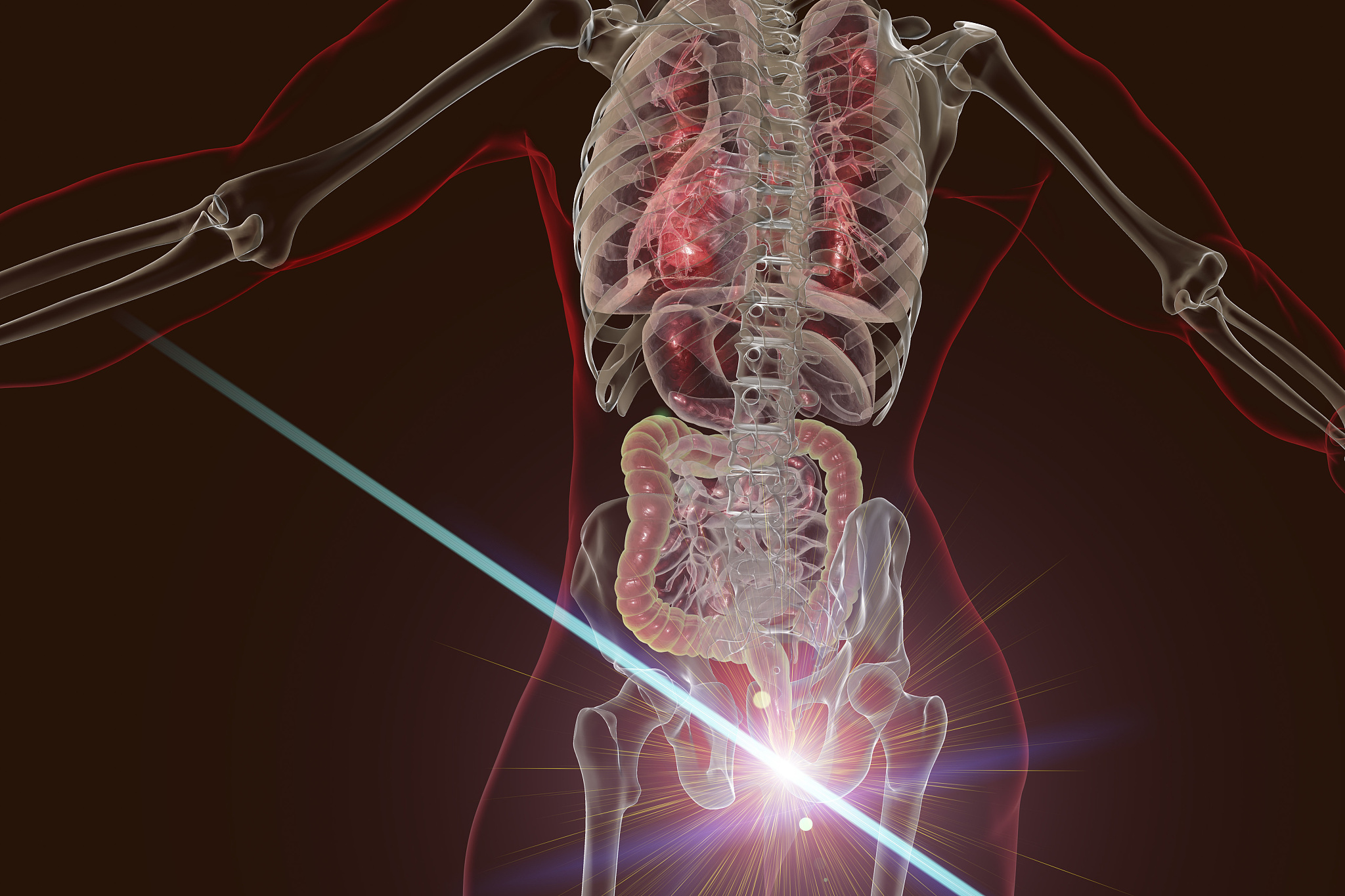 laser treatment of haemorrhoids, conceptual illustration