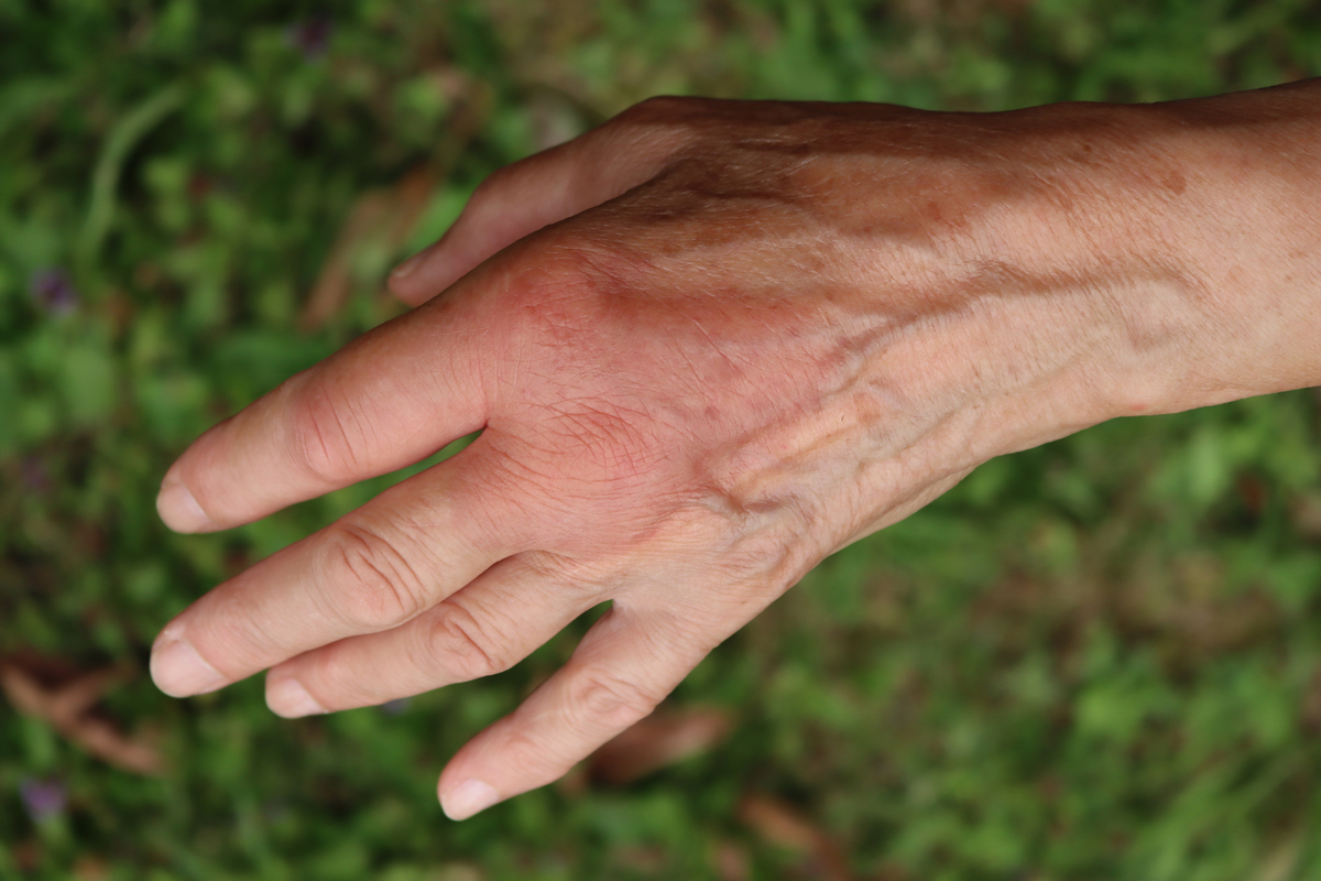 手皮黑点原因及治疗：湿疹、痤疮、细菌感染