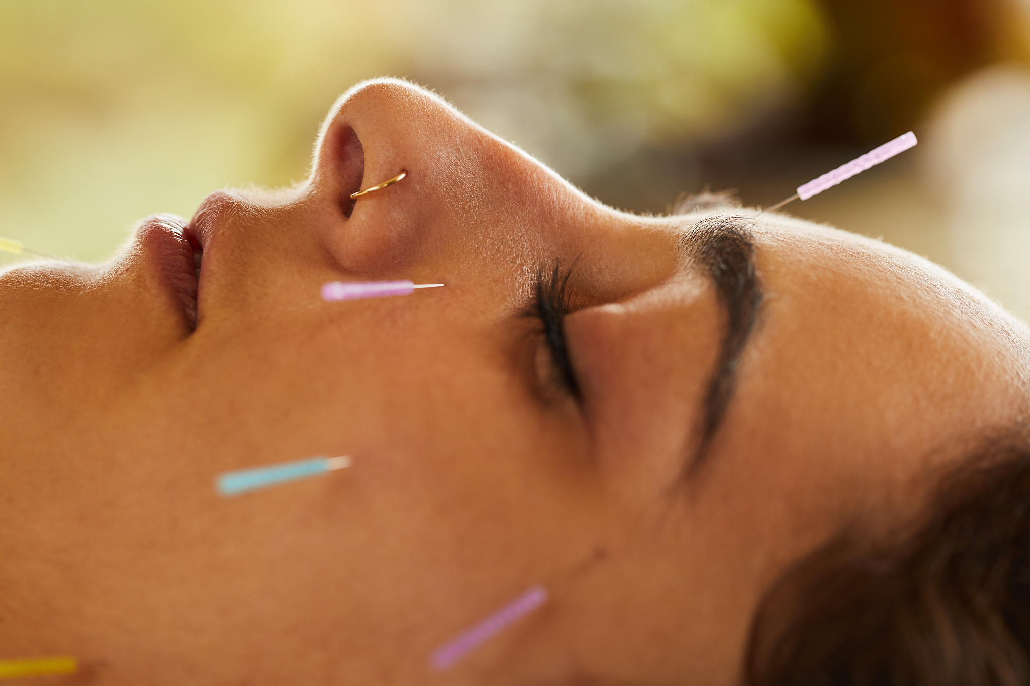 young woman having acupuncture done on her face