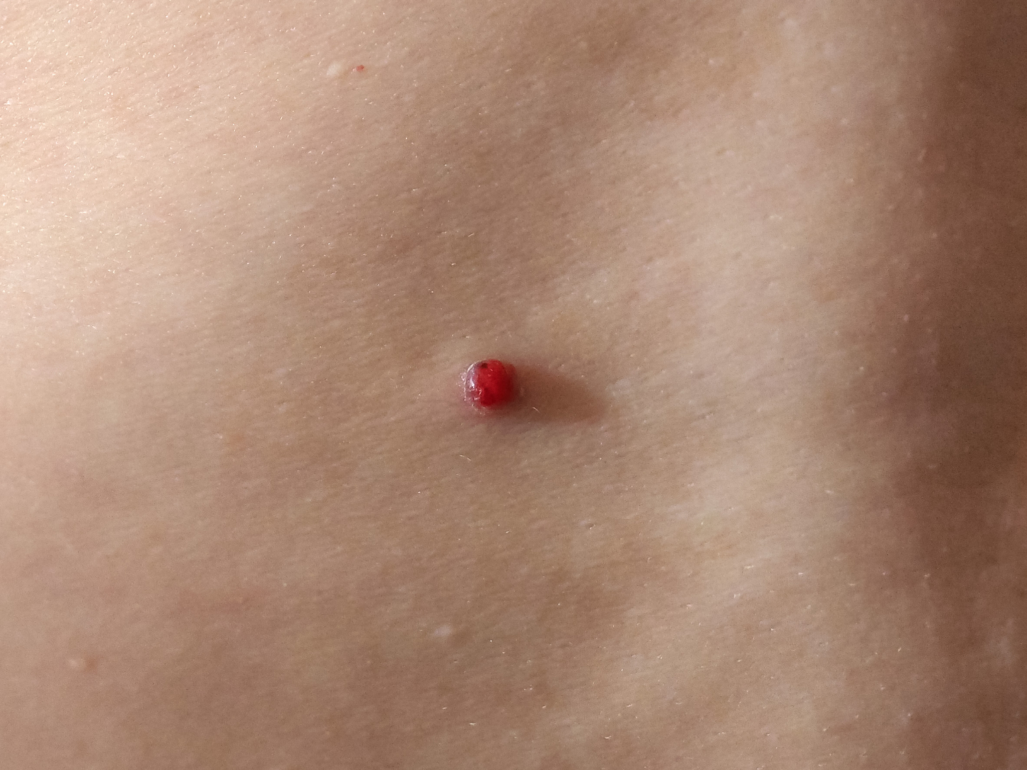 手臂红痣的原因：色素沉着、血管瘤、药物副作用等