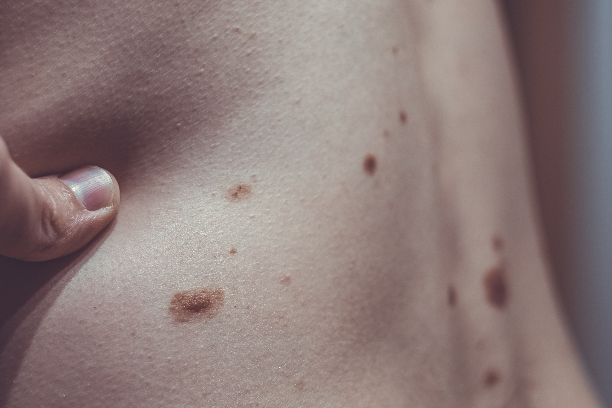 melanocytic nevus, some of them dyplastic or atypical, on a cauc