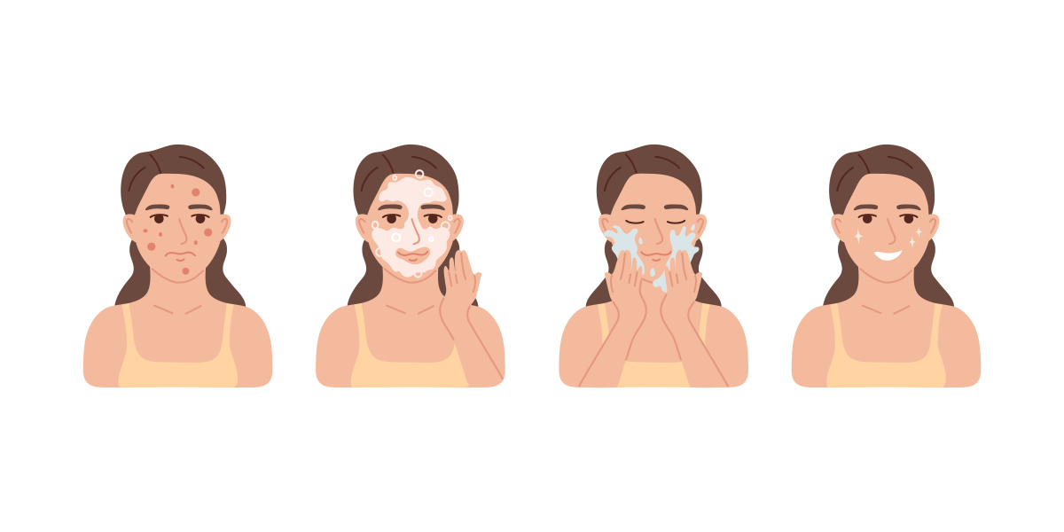 模仿小红书博主的风格写一个文案来介绍脂溢性皮炎的护理过程